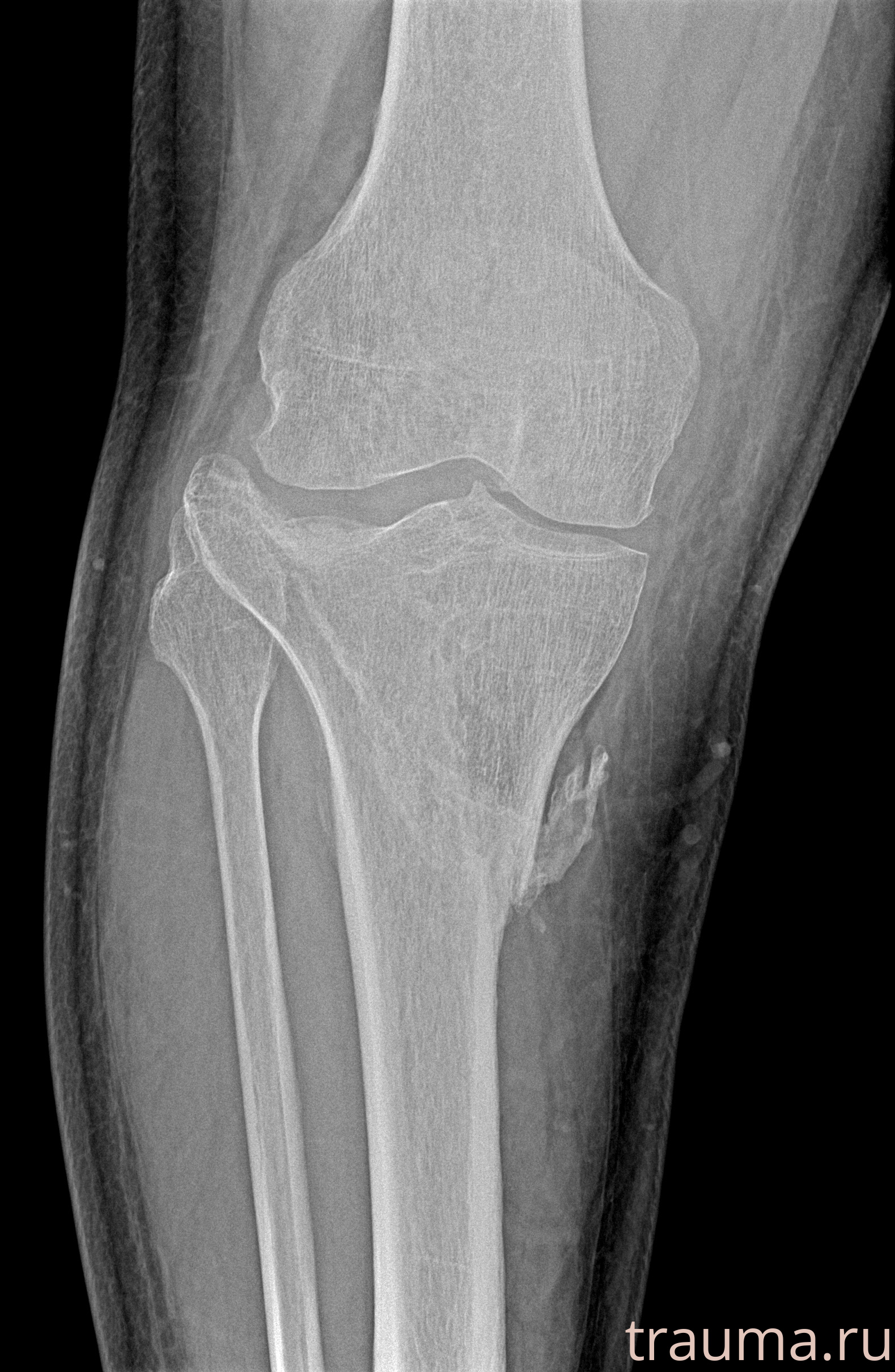 Рентген на дому: по вашему адресу приезжает врач-рентгенолог, травматолог-ортопед с мобильным рентгеновским аппаратом, проводит диагностику травмы или заболевания, делает необходимые рентгенограммы, дает рекомендации по дальнейшему лечению. Получить качественные снимки в домашних условиях возможно благодаря уникальной методике, разработанной МосРентген Центром для института  Склифосовского