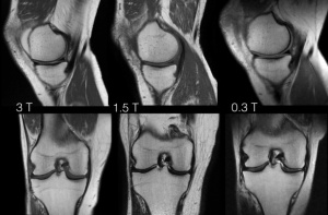 Исследование особенностей анатомии коленного сустава после оперативного вмешательства по данным магнитно-резонансной томографии
