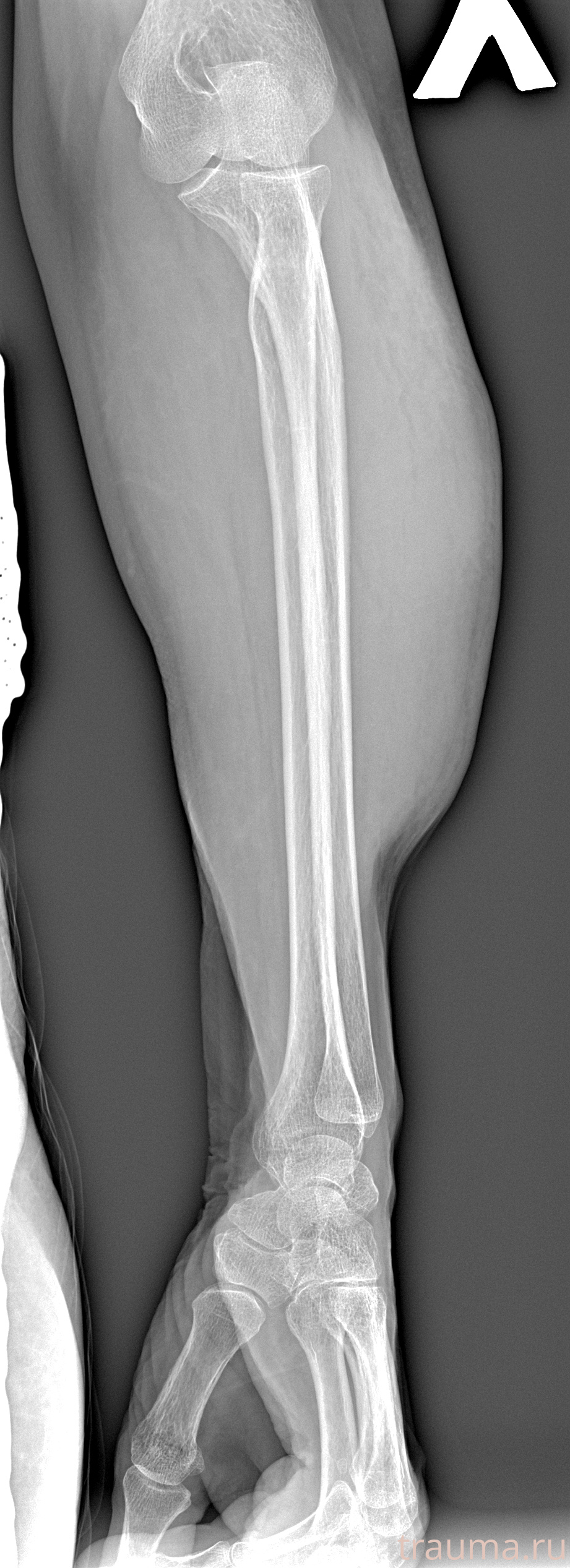 Рентген на дому: по вашему адресу приезжает врач-рентгенолог, травматолог-ортопед с мобильным рентгеновским аппаратом, проводит диагностику травмы или заболевания, делает необходимые рентгенограммы, дает рекомендации по дальнейшему лечению. Получить качественные снимки в домашних условиях возможно благодаря уникальной методике, разработанной МосРентген Центром для института  Склифосовского