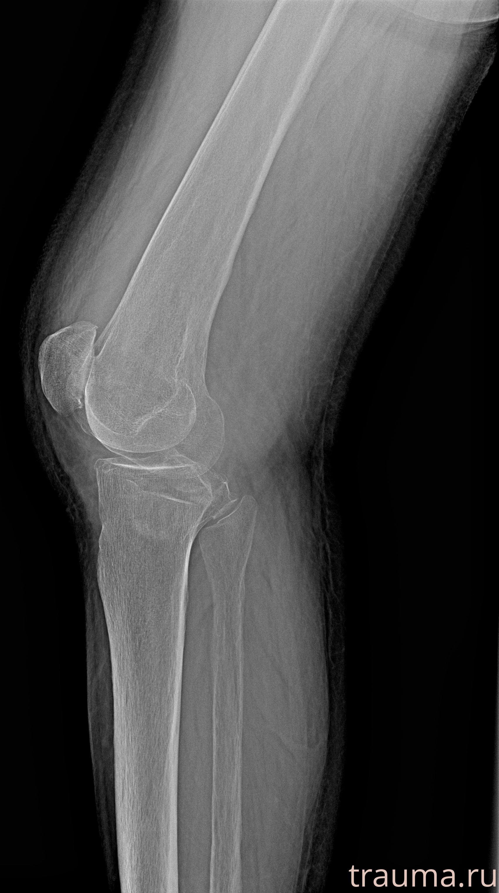Рентген на дому: по вашему адресу приезжает врач-рентгенолог, травматолог-ортопед с мобильным рентгеновским аппаратом, проводит диагностику травмы или заболевания, делает необходимые рентгенограммы, дает рекомендации по дальнейшему лечению. Получить качественные снимки в домашних условиях возможно благодаря уникальной методике, разработанной МосРентген Центром для института  Склифосовского