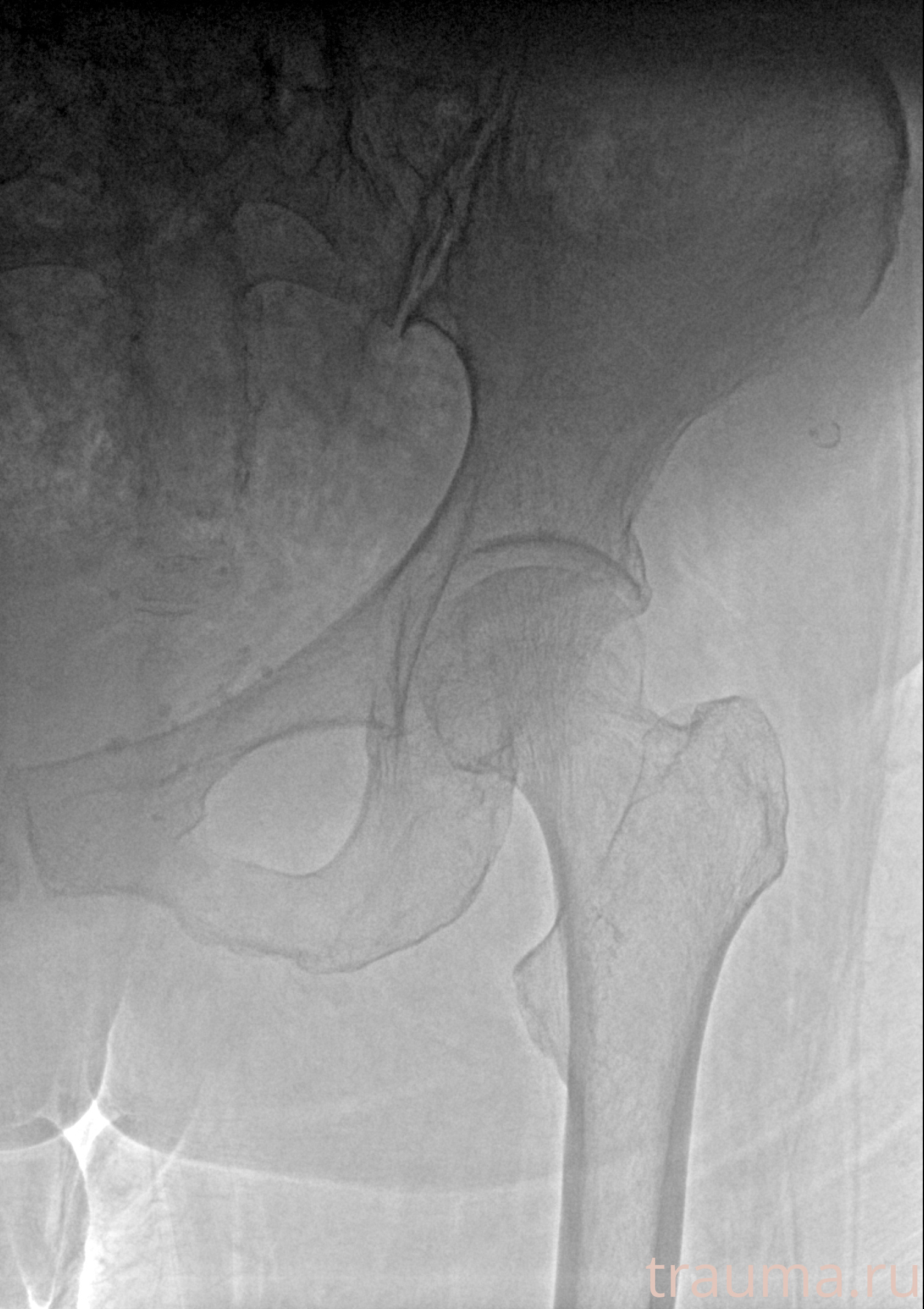 Рентген на дому: по вашему адресу приезжает врач-рентгенолог, травматолог-ортопед с мобильным рентгеновским аппаратом, проводит диагностику травмы или заболевания, делает необходимые рентгенограммы, дает рекомендации по дальнейшему лечению. Получить качественные снимки в домашних условиях возможно благодаря уникальной методике, разработанной МосРентген Центром для института  Склифосовского