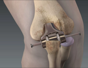 Клиническая эффективность и точность выравнивания механической оси при роботизированном тотальном эндопротезировании коленного сустава
