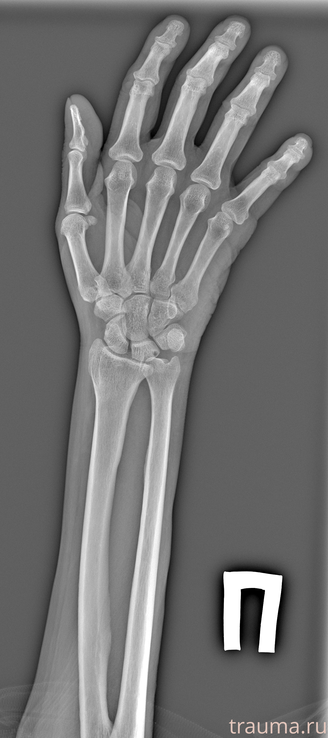 Рентген на дому: по вашему адресу приезжает врач-рентгенолог, травматолог-ортопед с мобильным рентгеновским аппаратом, проводит диагностику травмы или заболевания, делает необходимые рентгенограммы, дает рекомендации по дальнейшему лечению. Получить качественные снимки в домашних условиях возможно благодаря уникальной методике, разработанной МосРентген Центром для института  Склифосовского