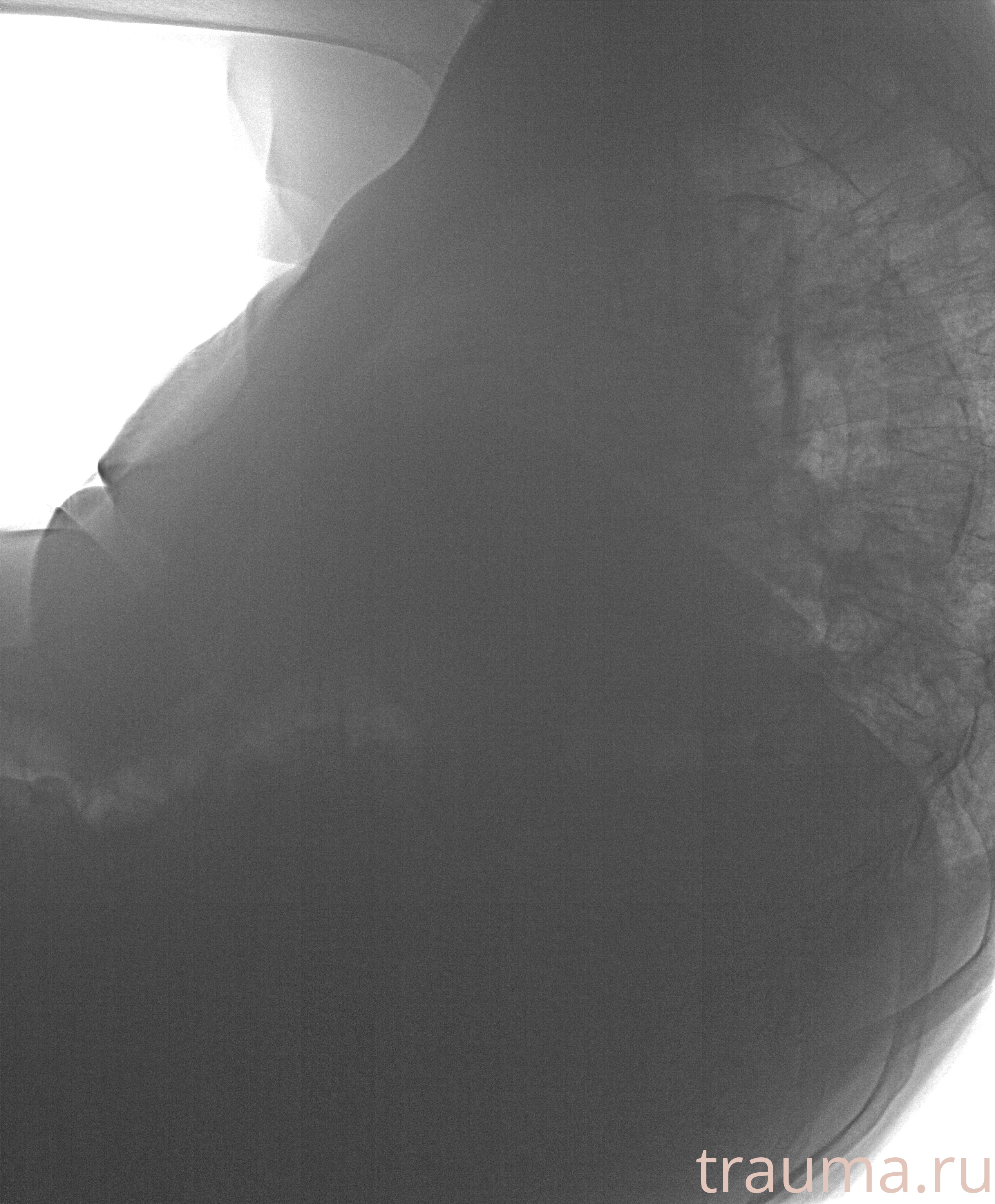 Рентген на дому: по вашему адресу приезжает врач-рентгенолог, травматолог-ортопед с мобильным рентгеновским аппаратом, проводит диагностику травмы или заболевания, делает необходимые рентгенограммы, дает рекомендации по дальнейшему лечению. Получить качественные снимки в домашних условиях возможно благодаря уникальной методике, разработанной МосРентген Центром для института  Склифосовского