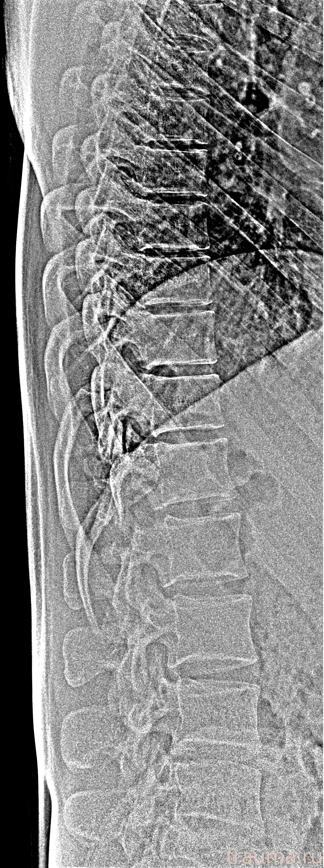 Рентген на дому: по вашему адресу приезжает врач-рентгенолог, травматолог-ортопед с мобильным рентгеновским аппаратом, проводит диагностику травмы или заболевания, делает необходимые рентгенограммы, дает рекомендации по дальнейшему лечению. Получить качественные снимки в домашних условиях возможно благодаря уникальной методике, разработанной МосРентген Центром для института  Склифосовского