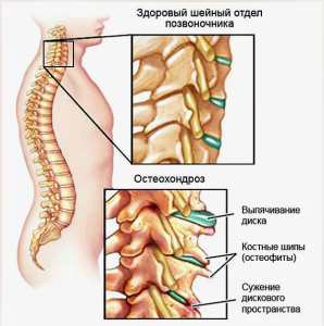 Как лечить остеохондроз пояснично-крестцового отдела позвоночника