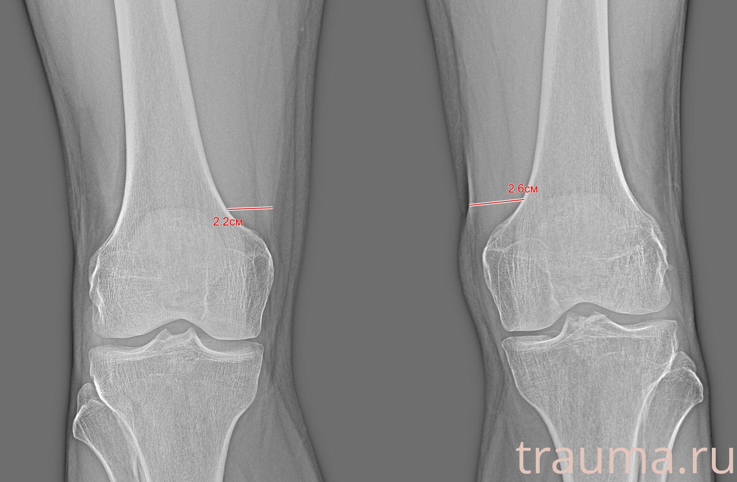Рентген на дому: по вашему адресу приезжает врач-рентгенолог, травматолог-ортопед с мобильным рентгеновским аппаратом, проводит диагностику травмы или заболевания, делает необходимые рентгенограммы, дает рекомендации по дальнейшему лечению. Получить качественные снимки в домашних условиях возможно благодаря уникальной методике, разработанной МосРентген Центром для института  Склифосовского