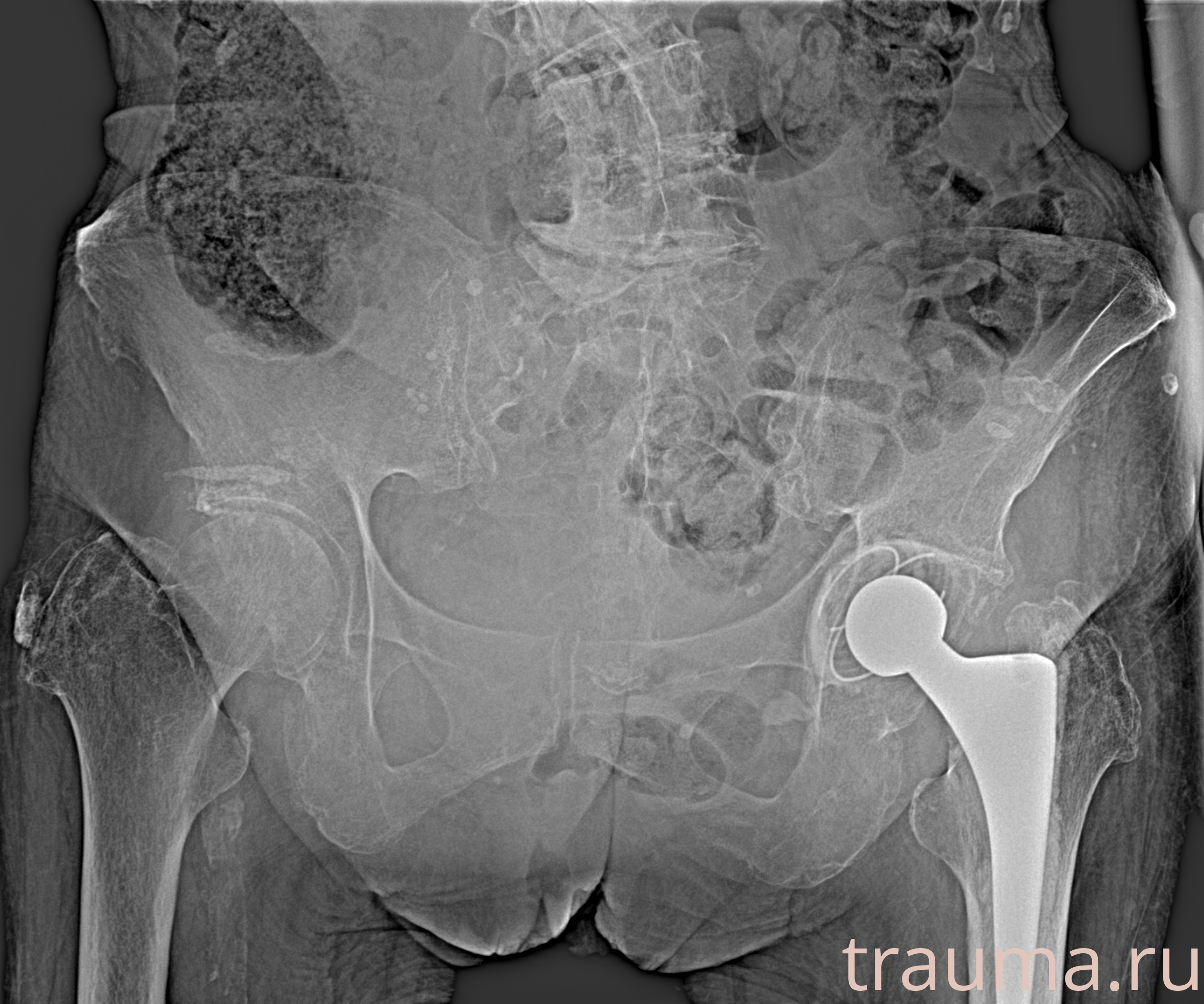 Рентген на дому: по вашему адресу приезжает врач-рентгенолог, травматолог-ортопед с мобильным рентгеновским аппаратом, проводит диагностику травмы или заболевания, делает необходимые рентгенограммы, дает рекомендации по дальнейшему лечению. Получить качественные снимки в домашних условиях возможно благодаря уникальной методике, разработанной МосРентген Центром для института  Склифосовского