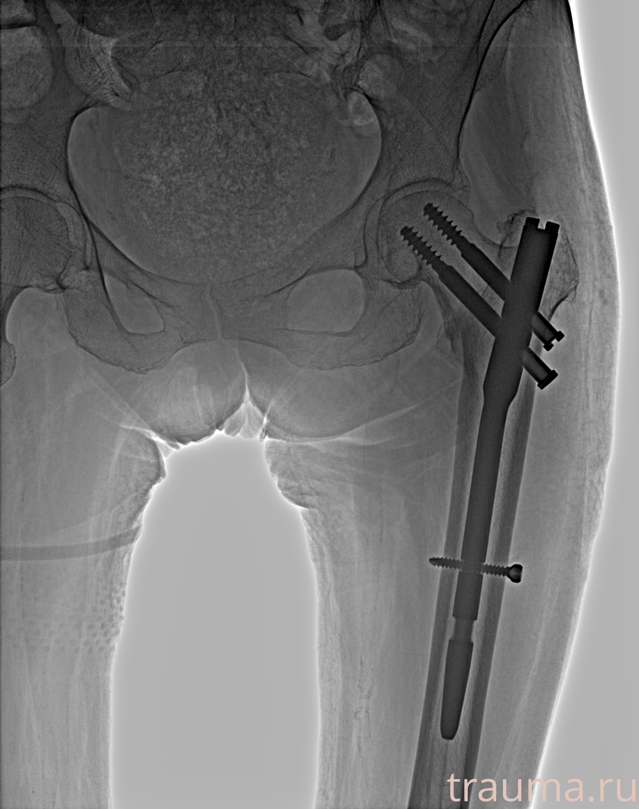 Рентген на дому: по вашему адресу приезжает врач-рентгенолог, травматолог-ортопед с мобильным рентгеновским аппаратом, проводит диагностику травмы или заболевания, делает необходимые рентгенограммы, дает рекомендации по дальнейшему лечению. Получить качественные снимки в домашних условиях возможно благодаря уникальной методике, разработанной МосРентген Центром для института  Склифосовского