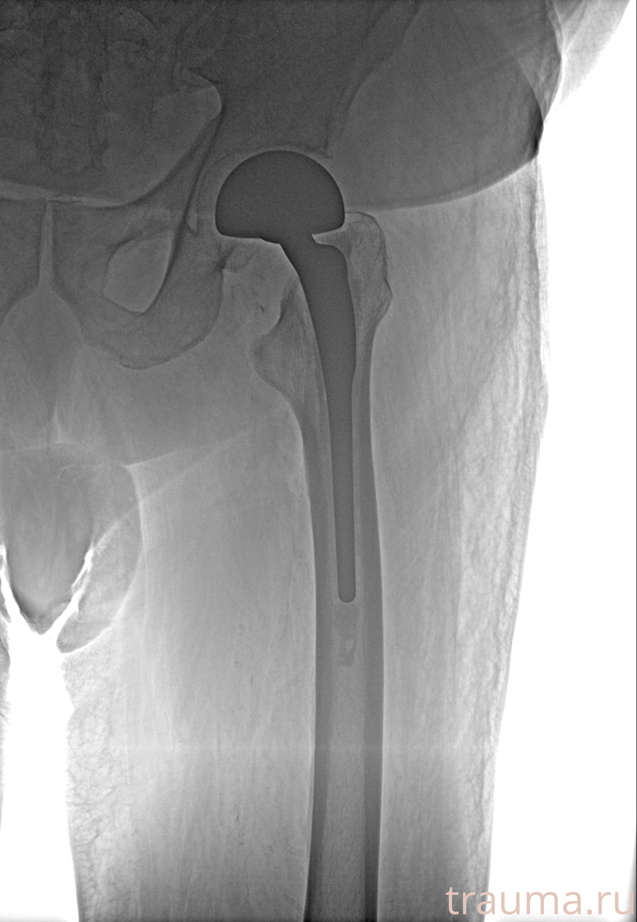 Рентген на дому: по вашему адресу приезжает врач-рентгенолог, травматолог-ортопед с мобильным рентгеновским аппаратом, проводит диагностику травмы или заболевания, делает необходимые рентгенограммы, дает рекомендации по дальнейшему лечению. Получить качественные снимки в домашних условиях возможно благодаря уникальной методике, разработанной МосРентген Центром для института  Склифосовского