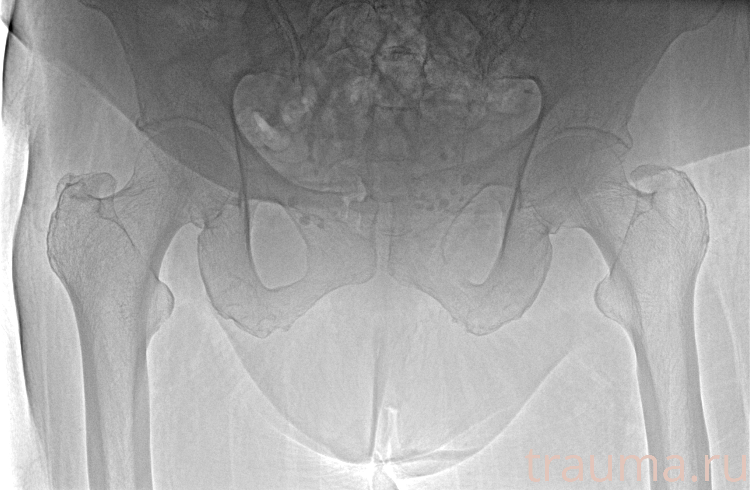 Рентген на дому: по вашему адресу приезжает врач-рентгенолог, травматолог-ортопед с мобильным рентгеновским аппаратом, проводит диагностику травмы или заболевания, делает необходимые рентгенограммы, дает рекомендации по дальнейшему лечению. Получить качественные снимки в домашних условиях возможно благодаря уникальной методике, разработанной МосРентген Центром для института  Склифосовского