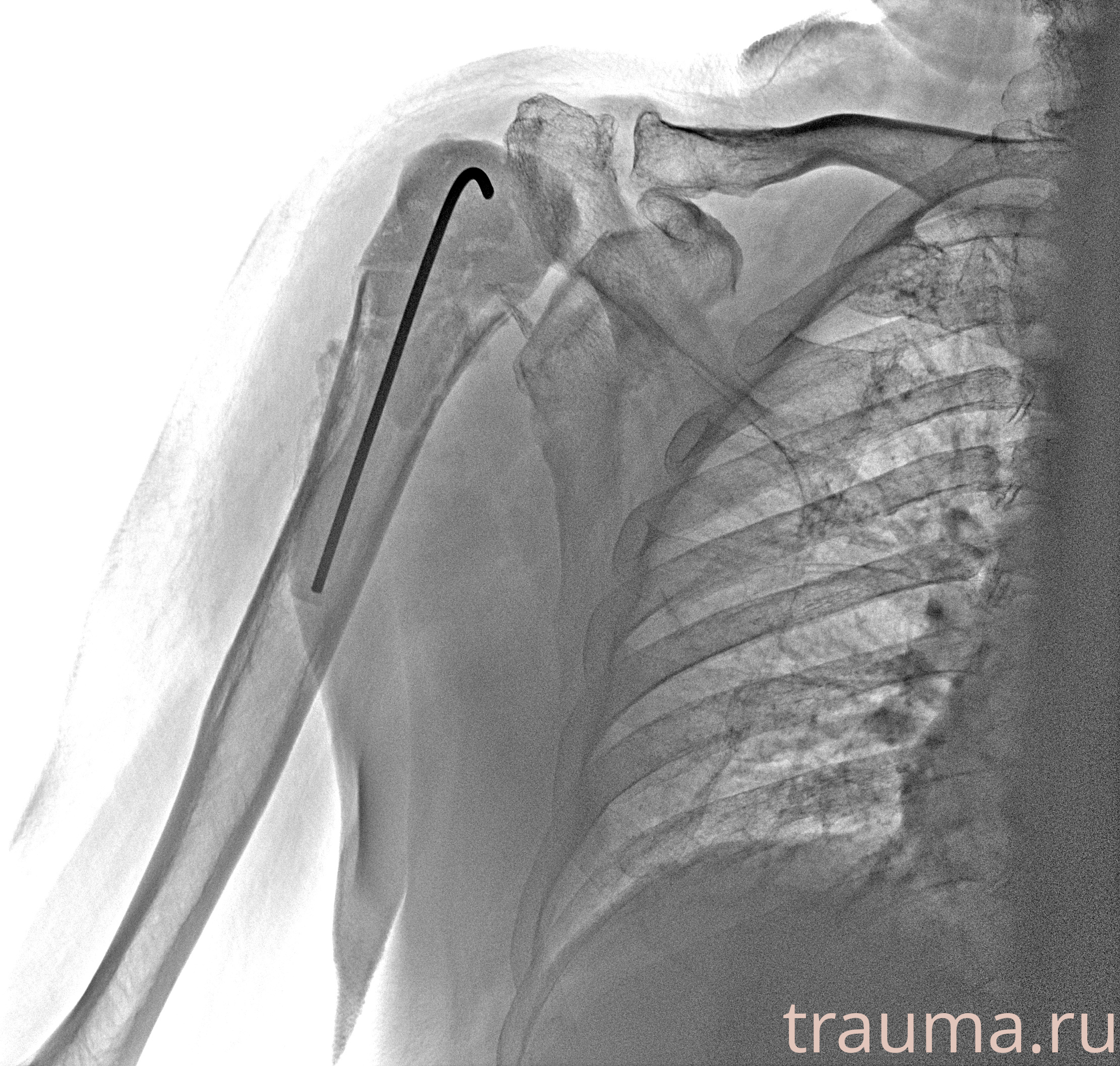 Рентген на дому: по вашему адресу приезжает врач-рентгенолог, травматолог-ортопед с мобильным рентгеновским аппаратом, проводит диагностику травмы или заболевания, делает необходимые рентгенограммы, дает рекомендации по дальнейшему лечению. Получить качественные снимки в домашних условиях возможно благодаря уникальной методике, разработанной МосРентген Центром для института  Склифосовского