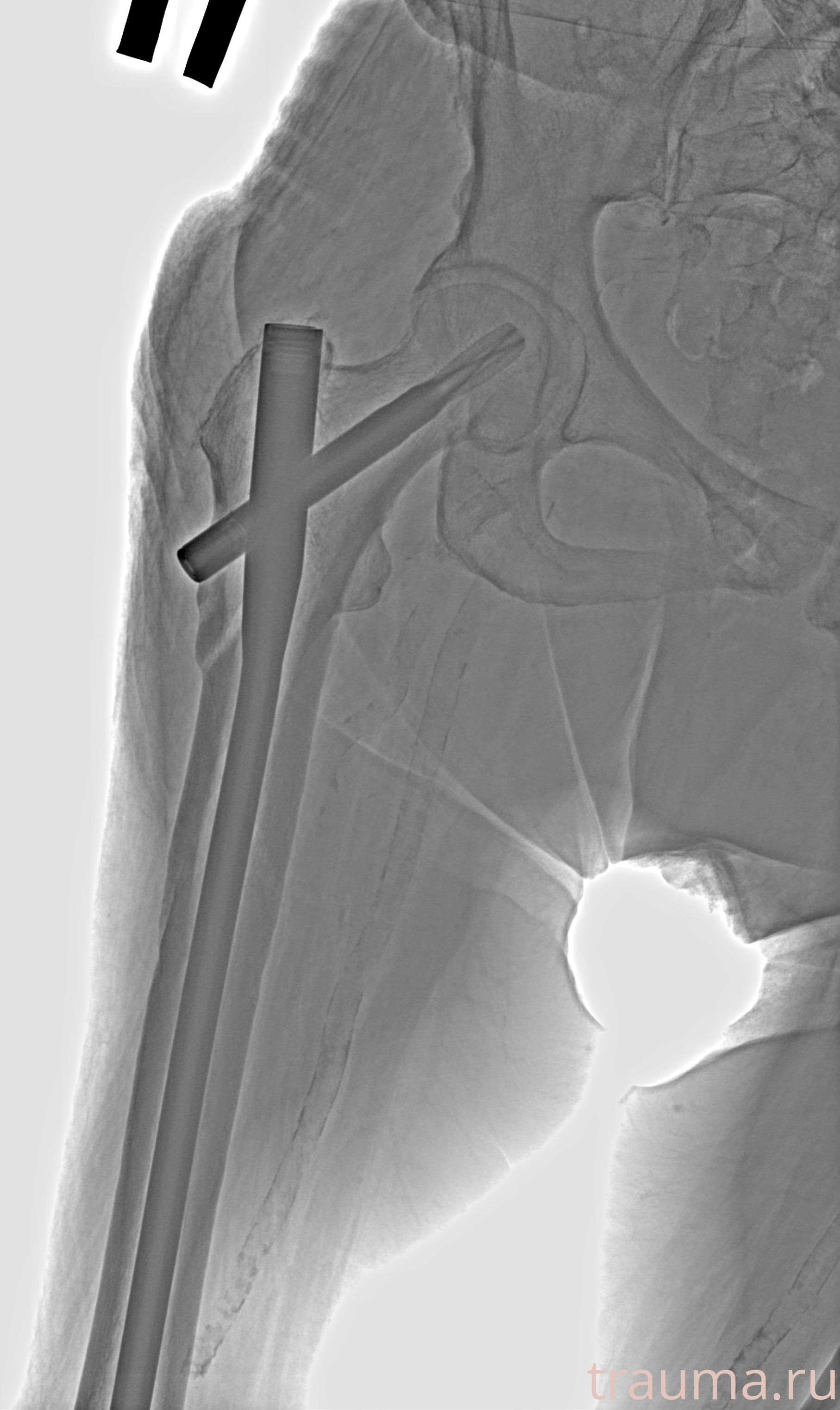 Рентген на дому: по вашему адресу приезжает врач-рентгенолог, травматолог-ортопед с мобильным рентгеновским аппаратом, проводит диагностику травмы или заболевания, делает необходимые рентгенограммы, дает рекомендации по дальнейшему лечению. Получить качественные снимки в домашних условиях возможно благодаря уникальной методике, разработанной МосРентген Центром для института  Склифосовского