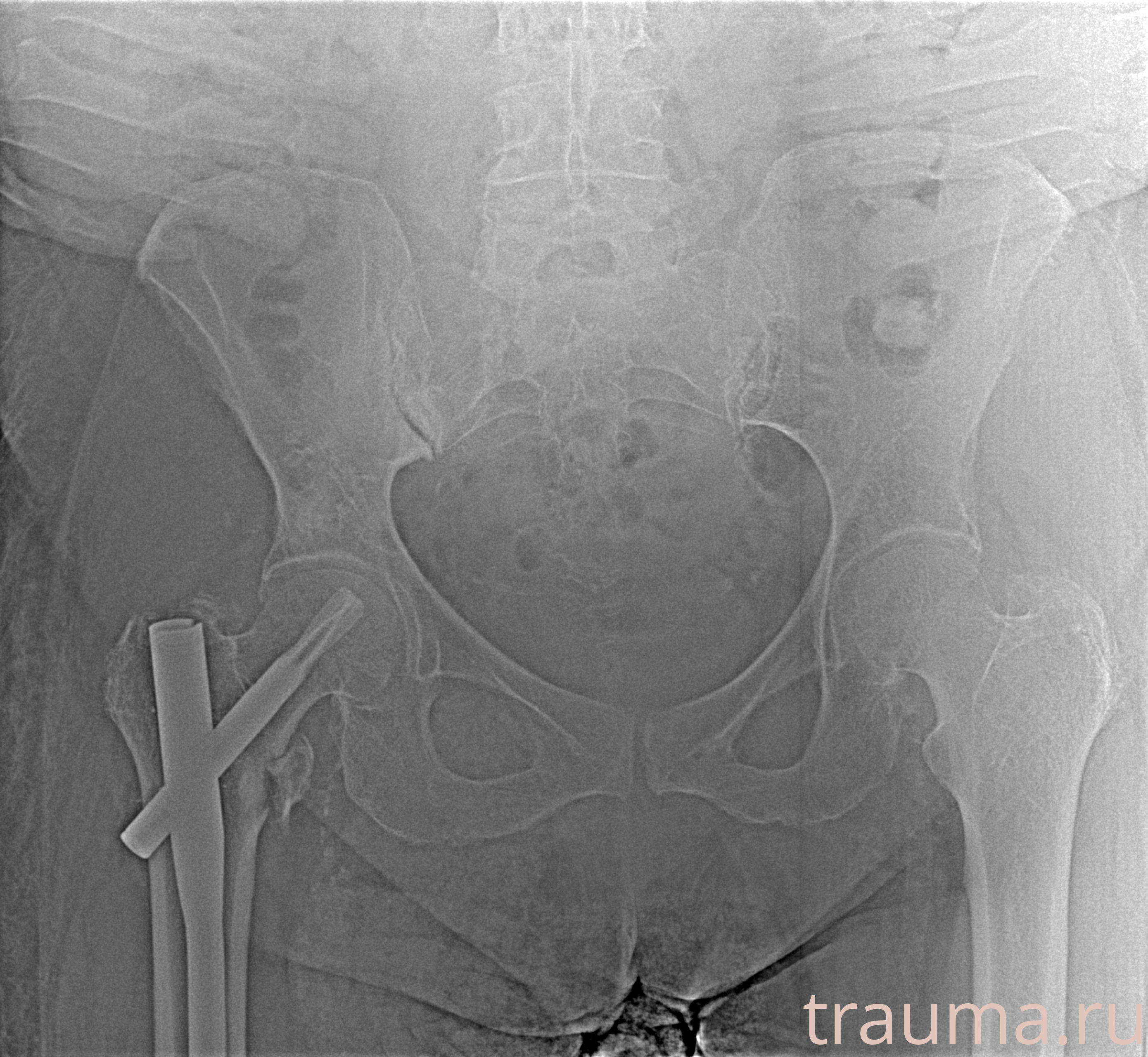 Рентген на дому: по вашему адресу приезжает врач-рентгенолог, травматолог-ортопед с мобильным рентгеновским аппаратом, проводит диагностику травмы или заболевания, делает необходимые рентгенограммы, дает рекомендации по дальнейшему лечению. Получить качественные снимки в домашних условиях возможно благодаря уникальной методике, разработанной МосРентген Центром для института  Склифосовского