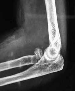 Рентген локтевого сустава