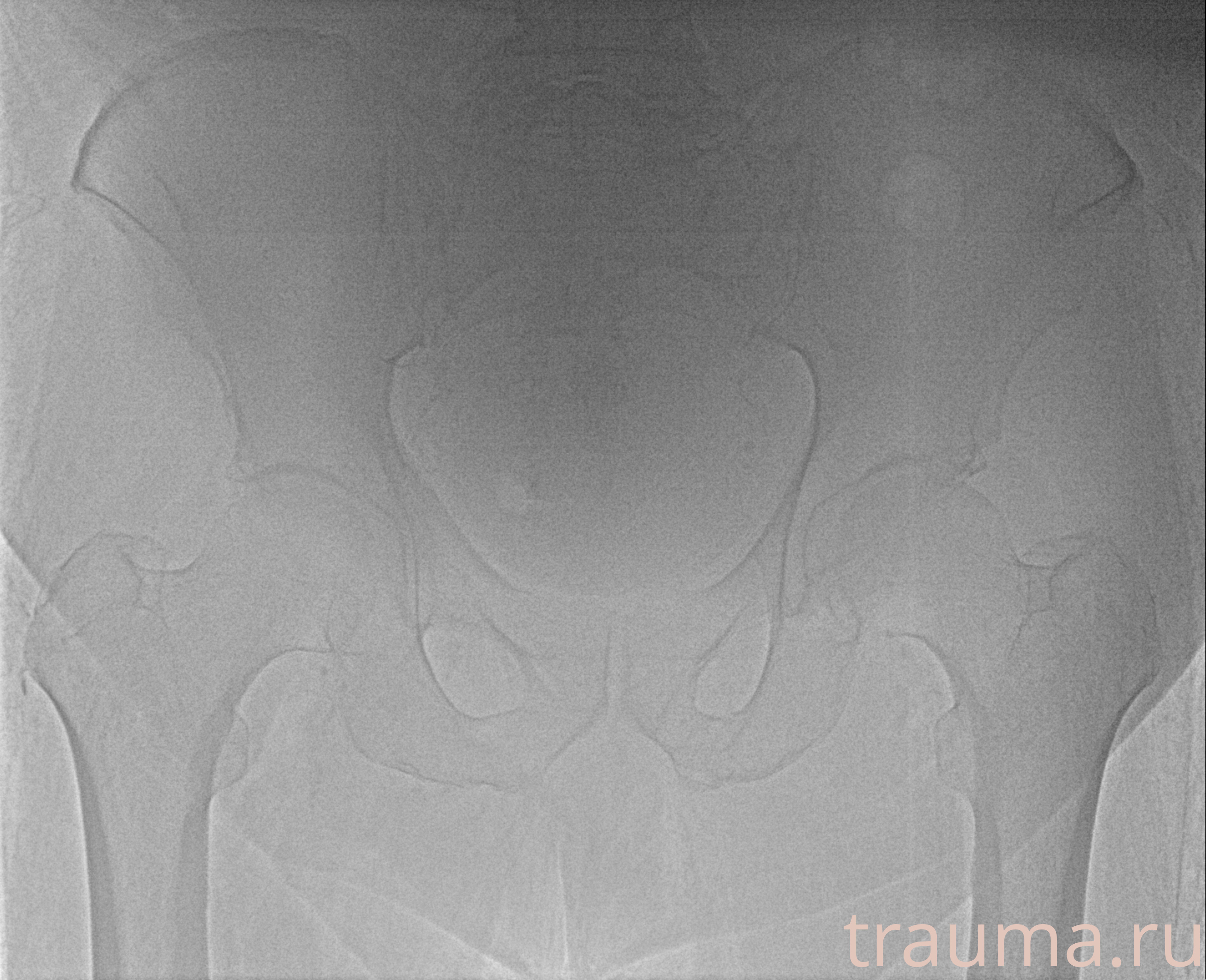 Рентген на дому: по вашему адресу приезжает врач-рентгенолог, травматолог-ортопед с мобильным рентгеновским аппаратом, проводит диагностику травмы или заболевания, делает необходимые рентгенограммы, дает рекомендации по дальнейшему лечению. Получить качественные снимки в домашних условиях возможно благодаря уникальной методике, разработанной МосРентген Центром для института  Склифосовского