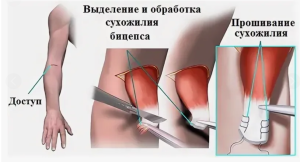 Опыт использования международной классификации функционирования при междисциплинарном подходе к лечению пациентов с повреждением дистального сухожилия двуглавой мышцы плеча