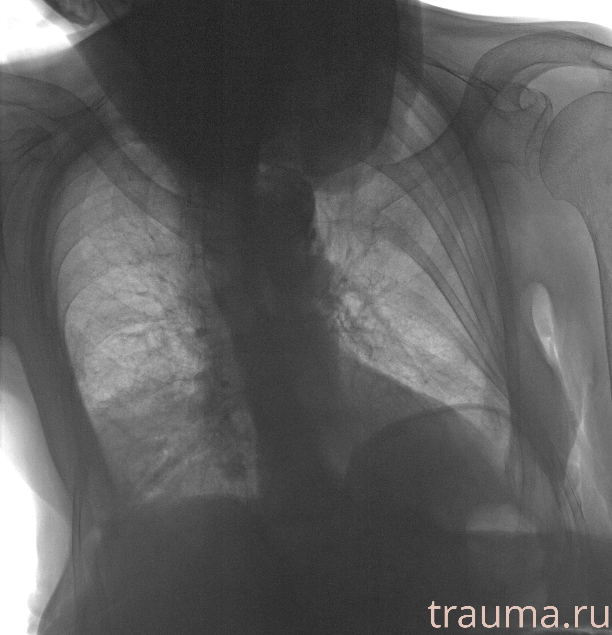 Рентген на дому: по вашему адресу приезжает врач-рентгенолог, травматолог-ортопед с мобильным рентгеновским аппаратом, проводит диагностику травмы или заболевания, делает необходимые рентгенограммы, дает рекомендации по дальнейшему лечению. Получить качественные снимки в домашних условиях возможно благодаря уникальной методике, разработанной МосРентген Центром для института  Склифосовского