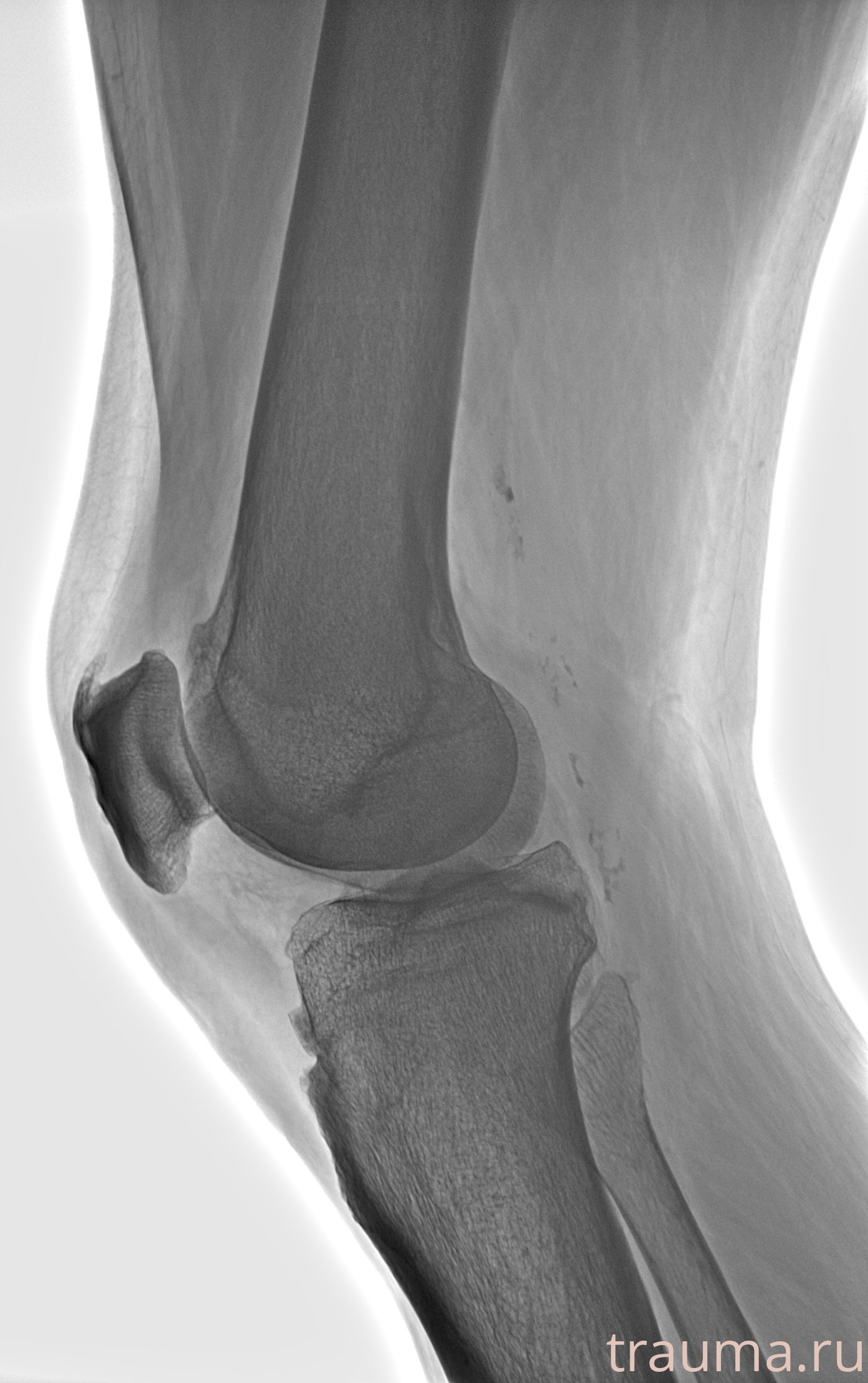 Рентген на дому: по вашему адресу приезжает врач-рентгенолог, травматолог-ортопед с мобильным рентгеновским аппаратом, проводит диагностику травмы или заболевания, делает необходимые рентгенограммы, дает рекомендации по дальнейшему лечению. Получить качественные снимки в домашних условиях возможно благодаря уникальной методике, разработанной МосРентген Центром для института  Склифосовского