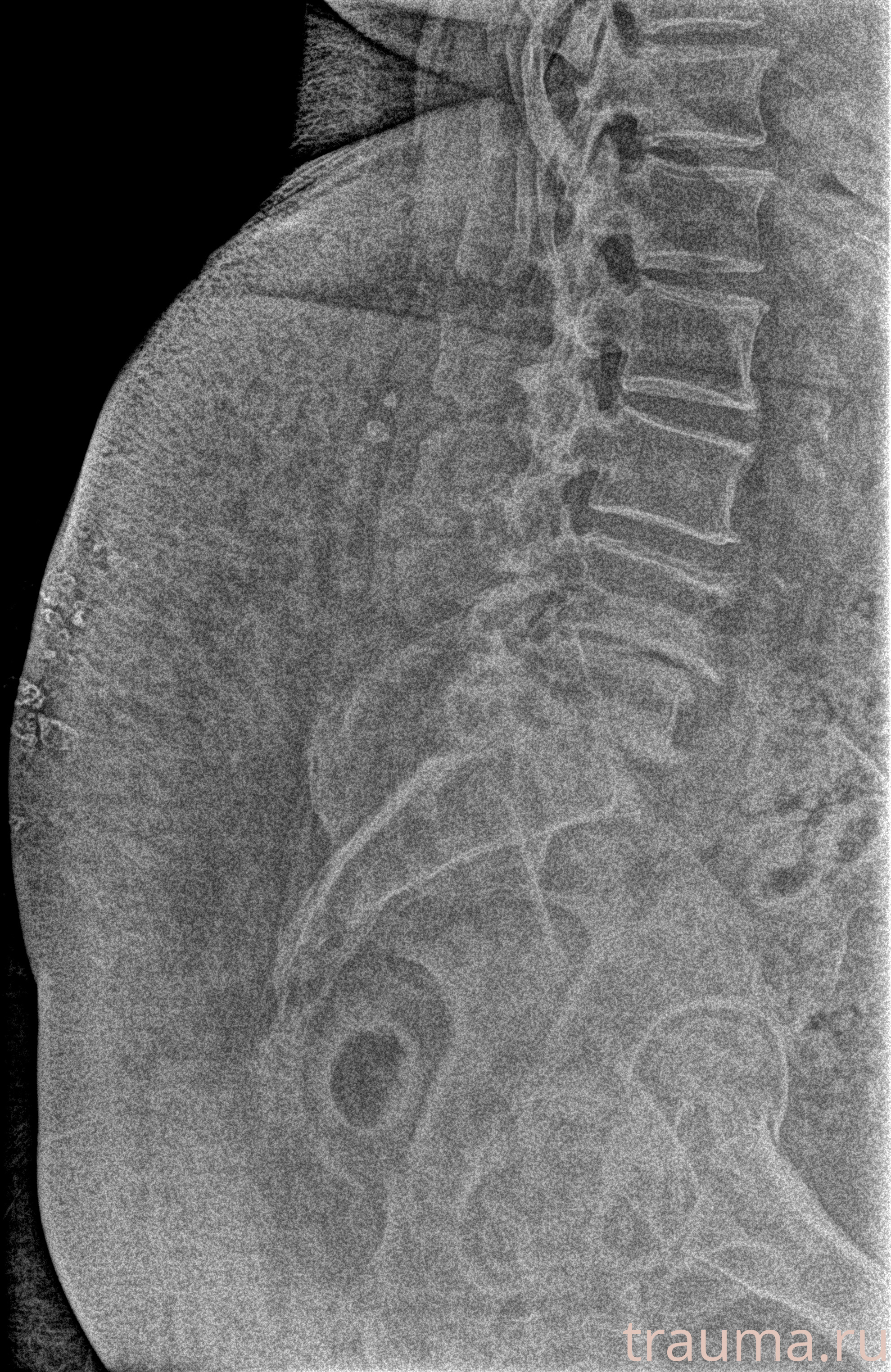 Рентген на дому: по вашему адресу приезжает врач-рентгенолог, травматолог-ортопед с мобильным рентгеновским аппаратом, проводит диагностику травмы или заболевания, делает необходимые рентгенограммы, дает рекомендации по дальнейшему лечению. Получить качественные снимки в домашних условиях возможно благодаря уникальной методике, разработанной МосРентген Центром для института  Склифосовского