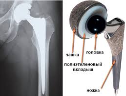 Стандартные элементы современных эндопротезов тазобедренного сустава