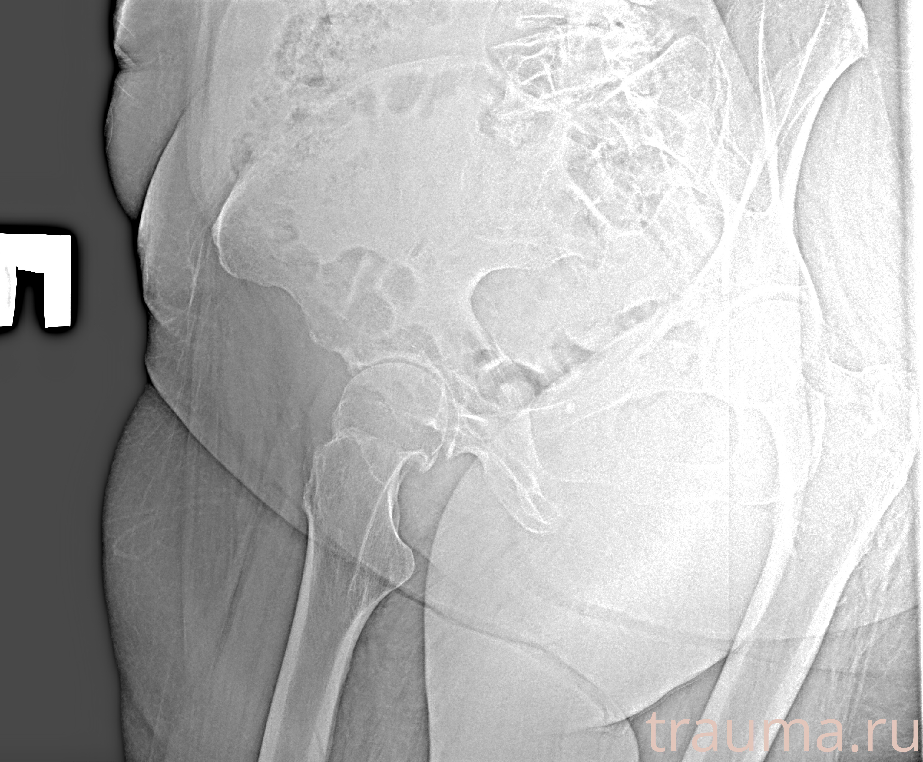 Рентген на дому: по вашему адресу приезжает врач-рентгенолог, травматолог-ортопед с мобильным рентгеновским аппаратом, проводит диагностику травмы или заболевания, делает необходимые рентгенограммы, дает рекомендации по дальнейшему лечению. Получить качественные снимки в домашних условиях возможно благодаря уникальной методике, разработанной МосРентген Центром для института  Склифосовского