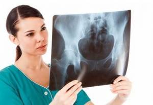 Рентгенологическая оценка эндопротезирования артропластики тазобедренного сустава