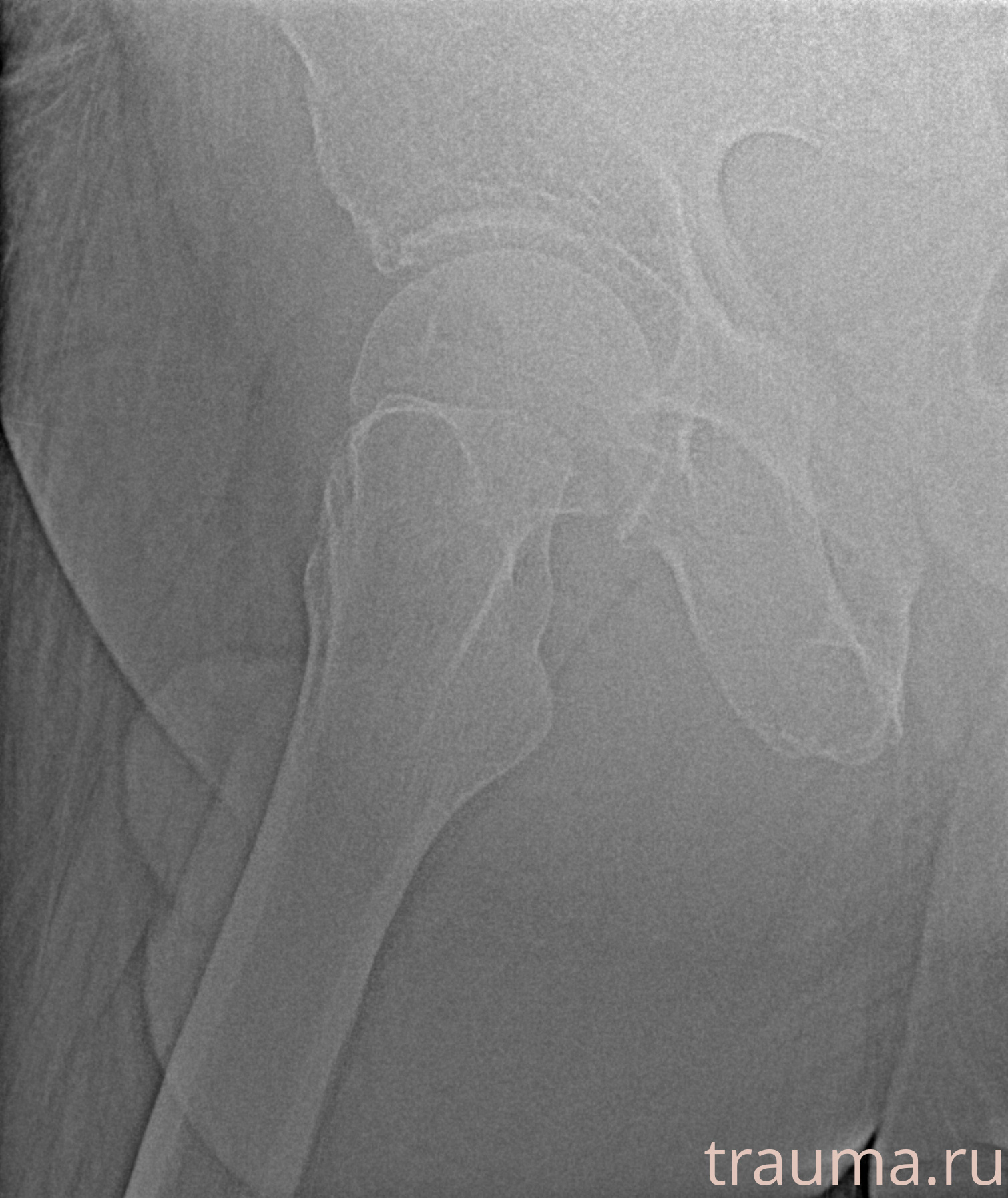 Рентген на дому: по вашему адресу приезжает врач-рентгенолог, травматолог-ортопед с мобильным рентгеновским аппаратом, проводит диагностику травмы или заболевания, делает необходимые рентгенограммы, дает рекомендации по дальнейшему лечению. Получить качественные снимки в домашних условиях возможно благодаря уникальной методике, разработанной МосРентген Центром для института  Склифосовского
