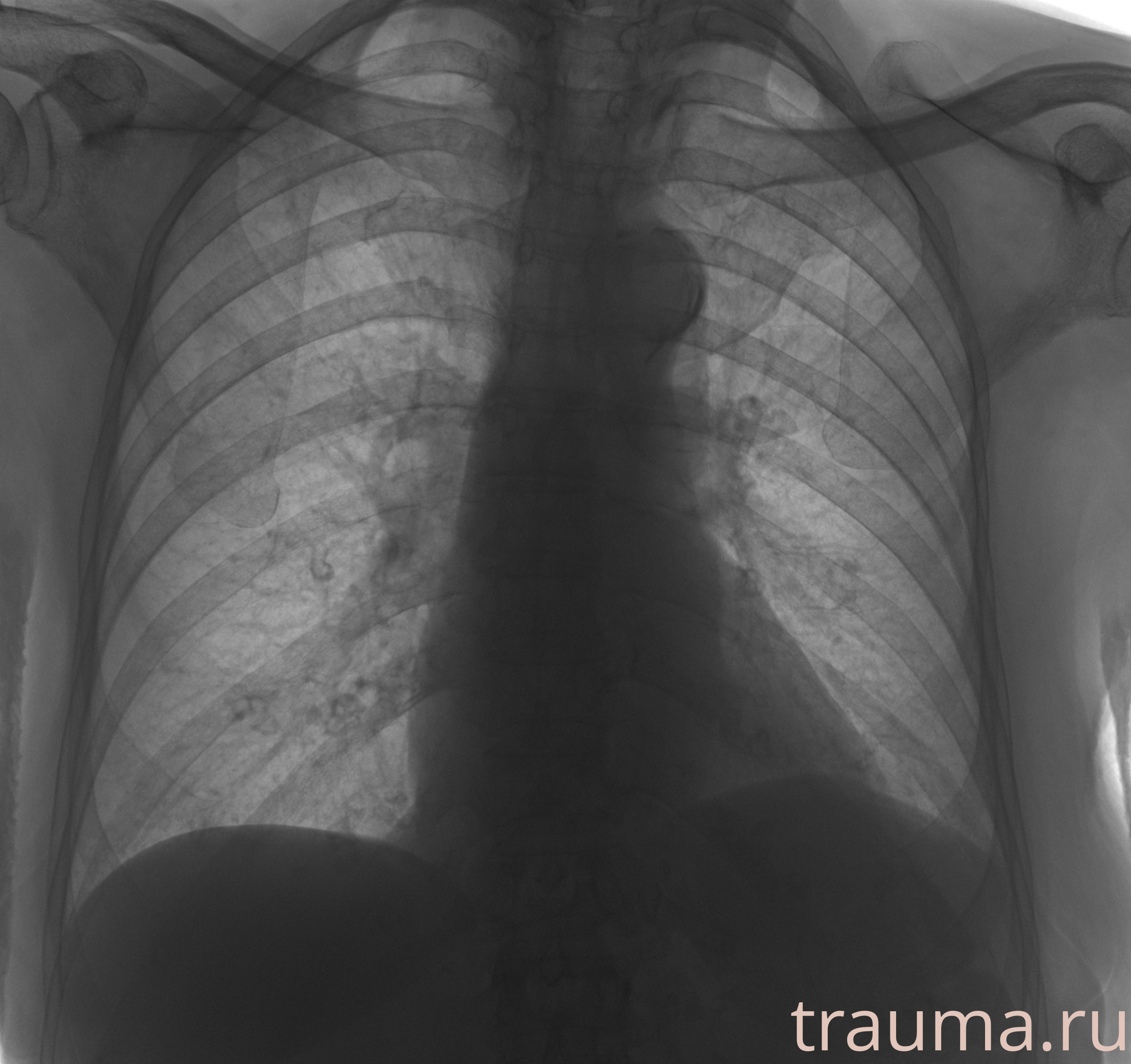 Рентген на дому: по вашему адресу приезжает врач-рентгенолог, травматолог-ортопед с мобильным рентгеновским аппаратом, проводит диагностику травмы или заболевания, делает необходимые рентгенограммы, дает рекомендации по дальнейшему лечению. Получить качественные снимки в домашних условиях возможно благодаря уникальной методике, разработанной МосРентген Центром для института  Склифосовского