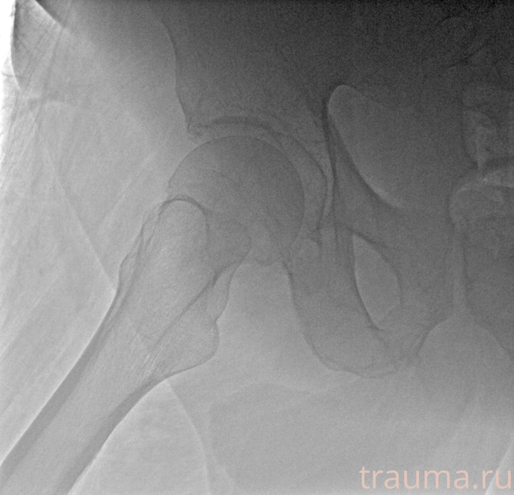 Рентген на дому: по вашему адресу приезжает врач-рентгенолог, травматолог-ортопед с мобильным рентгеновским аппаратом, проводит диагностику травмы или заболевания, делает необходимые рентгенограммы, дает рекомендации по дальнейшему лечению. Получить качественные снимки в домашних условиях возможно благодаря уникальной методике, разработанной МосРентген Центром для института  Склифосовского