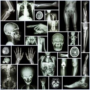 Классификация переломов костей