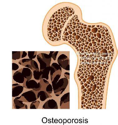 Остеопороз может привести к перелому шейки бедра