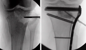 Выбор хирургического доступа при остеосинтезе переломов дистального метаэпифиза большеберцовой кости