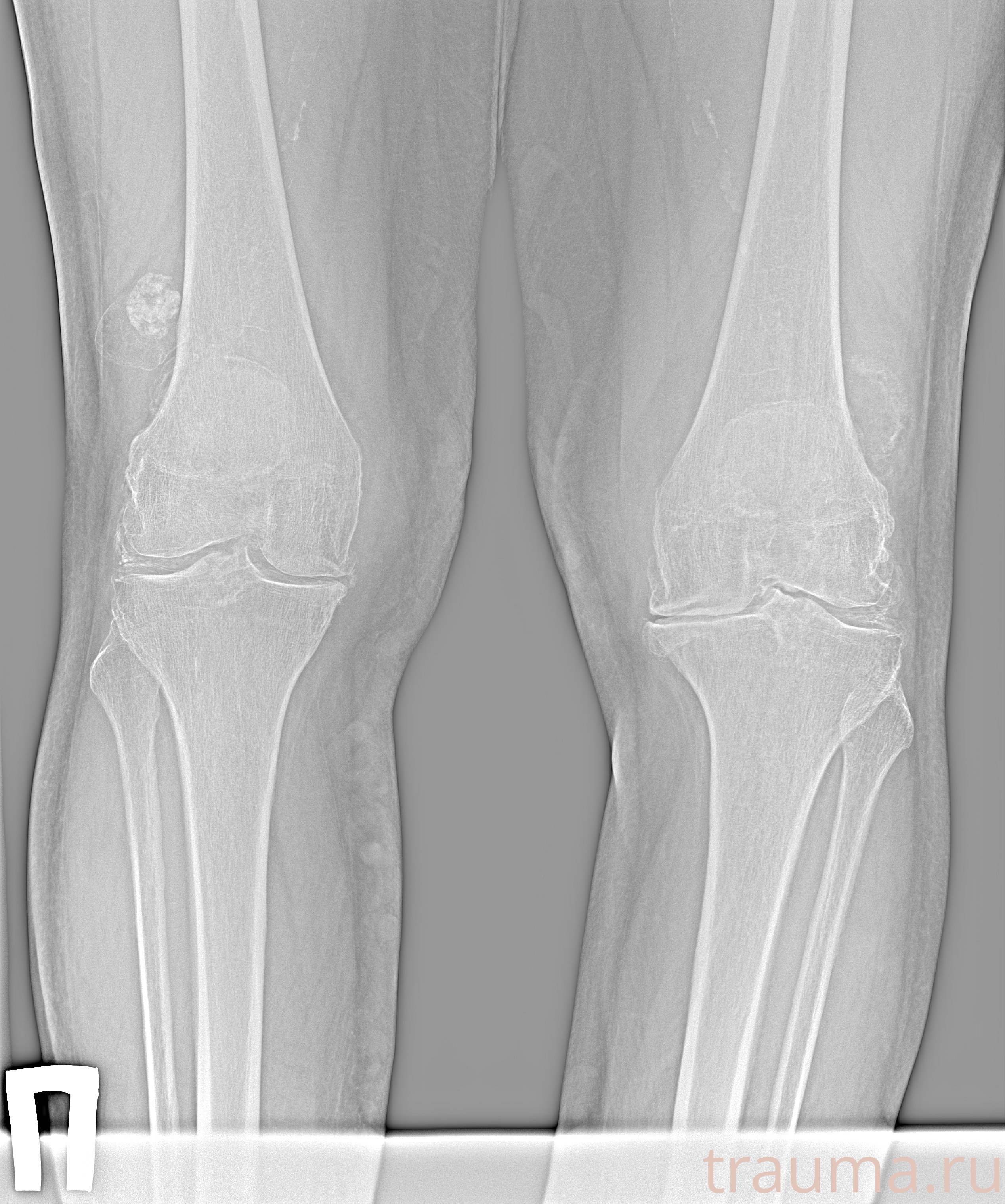 Рентген на дому: по вашему адресу приезжает врач-рентгенолог, травматолог-ортопед с мобильным рентгеновским аппаратом, проводит диагностику травмы или заболевания, делает необходимые рентгенограммы, дает рекомендации по дальнейшему лечению. Получить качественные снимки в домашних условиях возможно благодаря уникальной методике, разработанной МосРентген Центром для института  Склифосовского