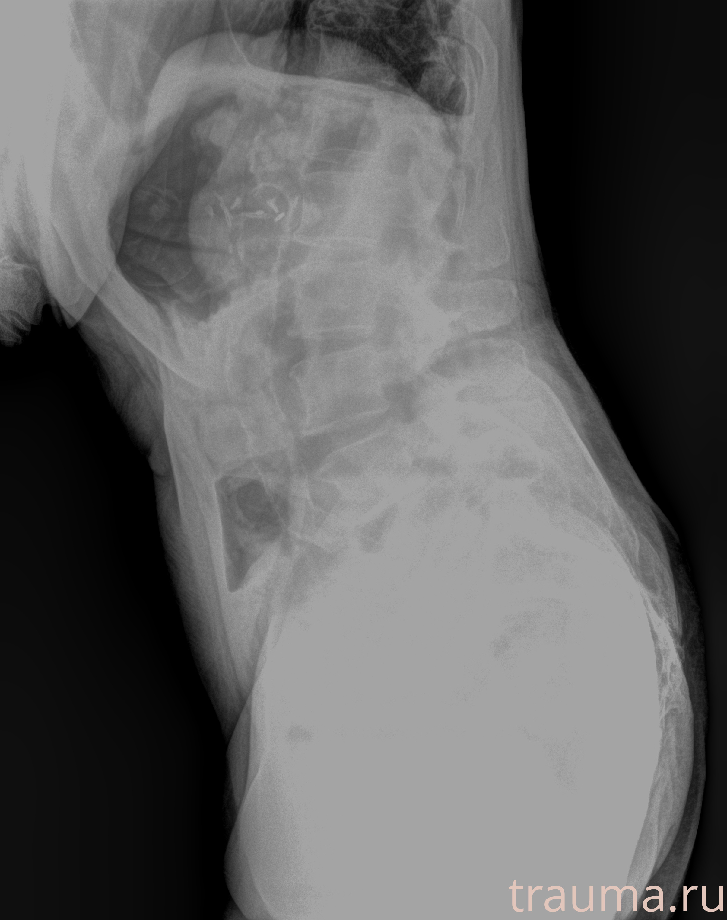 Рентген на дому: по вашему адресу приезжает врач-рентгенолог, травматолог-ортопед с мобильным рентгеновским аппаратом, проводит диагностику травмы или заболевания, делает необходимые рентгенограммы, дает рекомендации по дальнейшему лечению. Получить качественные снимки в домашних условиях возможно благодаря уникальной методике, разработанной МосРентген Центром для института  Склифосовского