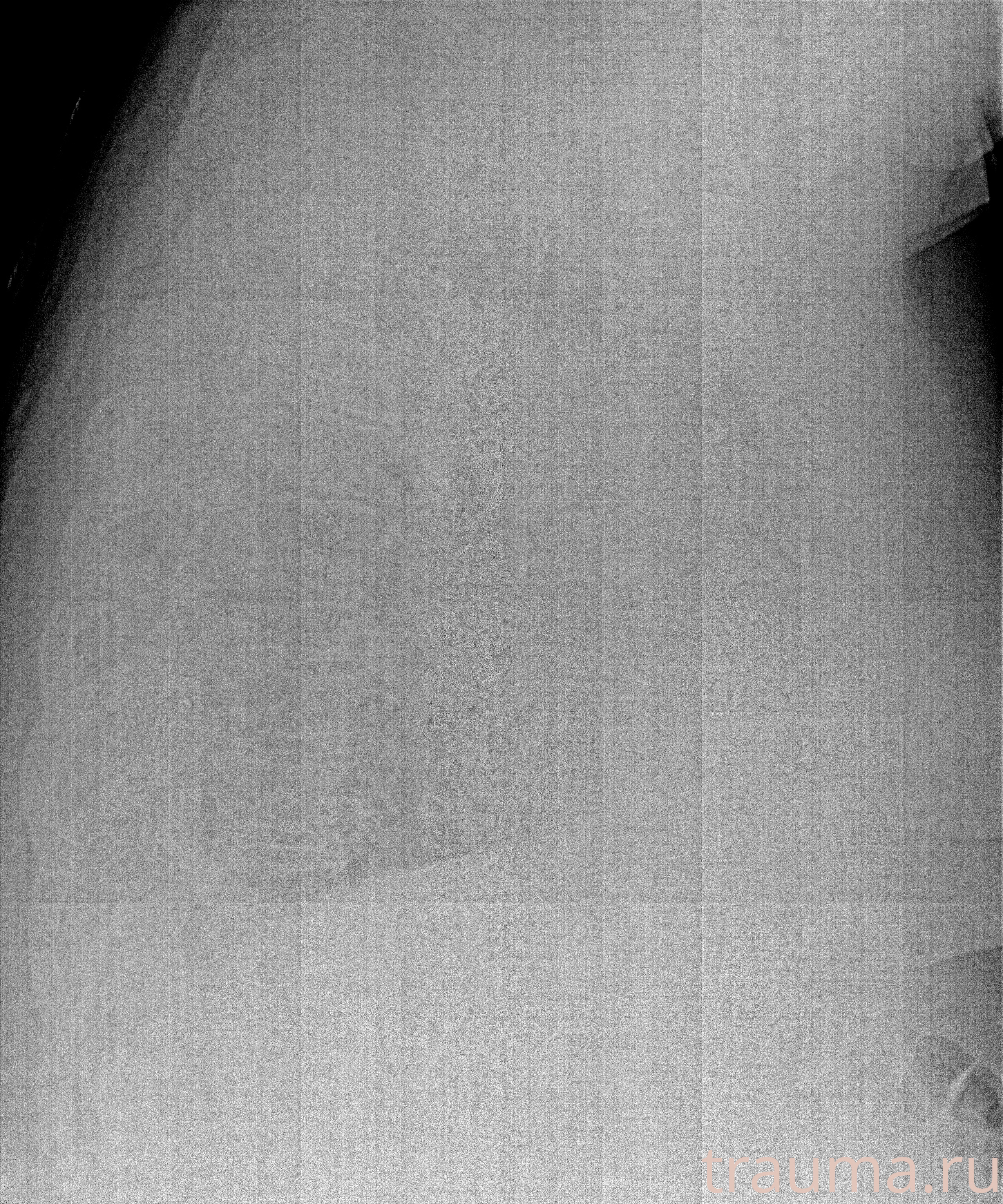 Рентген на дому: по вашему адресу приезжает врач-рентгенолог, травматолог-ортопед с мобильным рентгеновским аппаратом, проводит диагностику травмы или заболевания, делает необходимые рентгенограммы, дает рекомендации по дальнейшему лечению. Получить качественные снимки в домашних условиях возможно благодаря уникальной методике, разработанной МосРентген Центром для института  Склифосовского