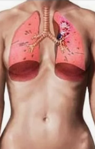 Адъювантная терапия ALK-позитивного рака легких: клинический случай