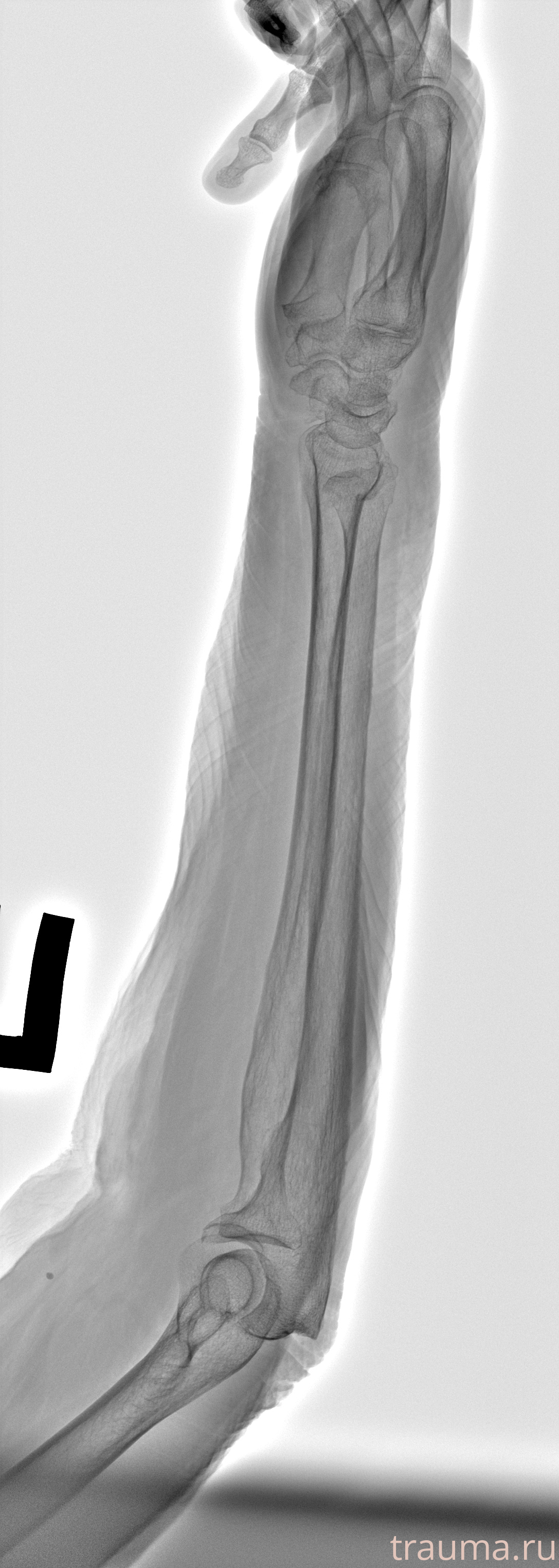 Рентген на дому: по вашему адресу приезжает врач-рентгенолог, травматолог-ортопед с мобильным рентгеновским аппаратом, проводит диагностику травмы или заболевания, делает необходимые рентгенограммы, дает рекомендации по дальнейшему лечению. Получить качественные снимки в домашних условиях возможно благодаря уникальной методике, разработанной МосРентген Центром для института  Склифосовского