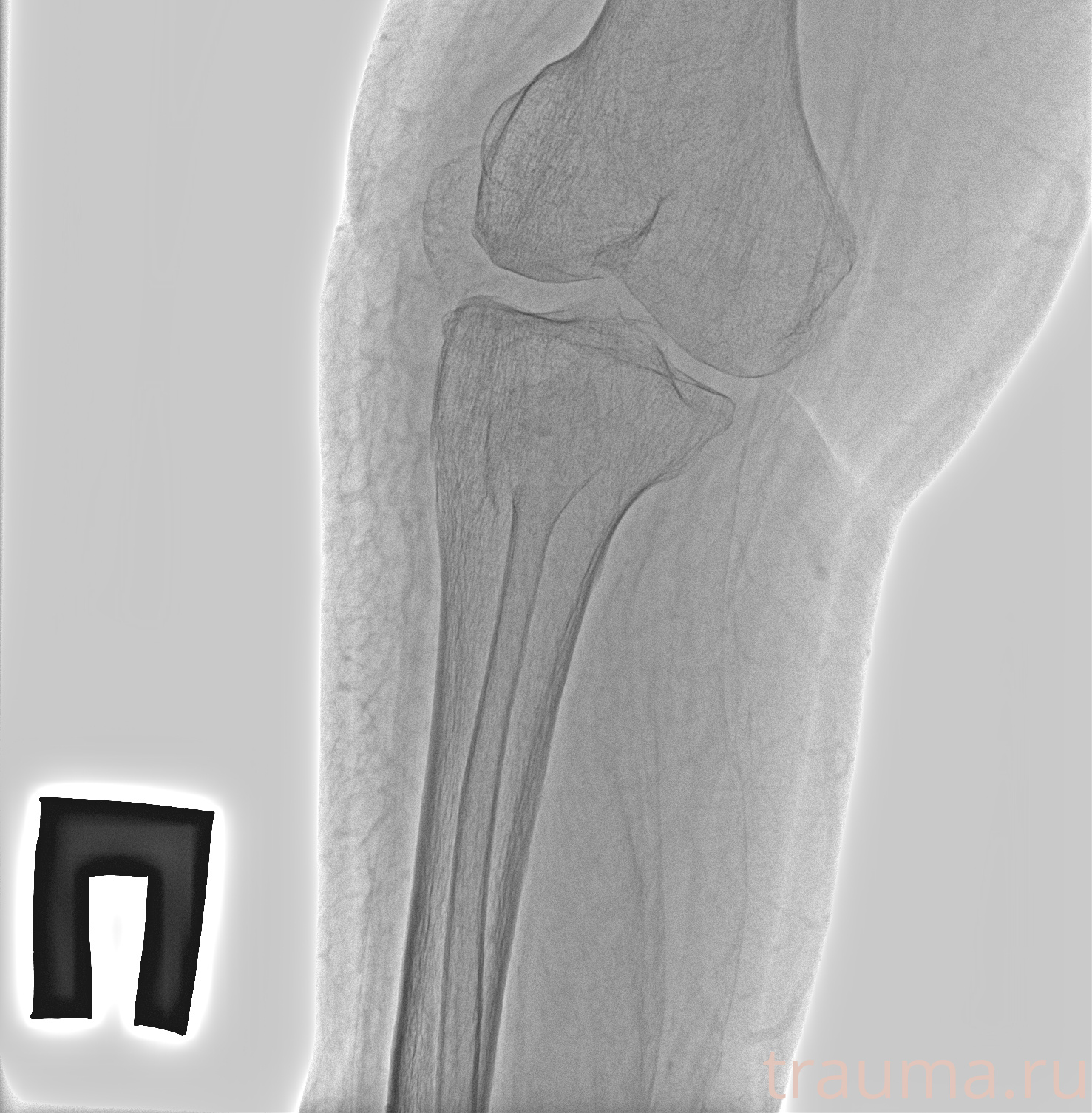 Рентген на дому: по вашему адресу приезжает врач-рентгенолог, травматолог-ортопед с мобильным рентгеновским аппаратом, проводит диагностику травмы или заболевания, делает необходимые рентгенограммы, дает рекомендации по дальнейшему лечению. Получить качественные снимки в домашних условиях возможно благодаря уникальной методике, разработанной МосРентген Центром для института  Склифосовского