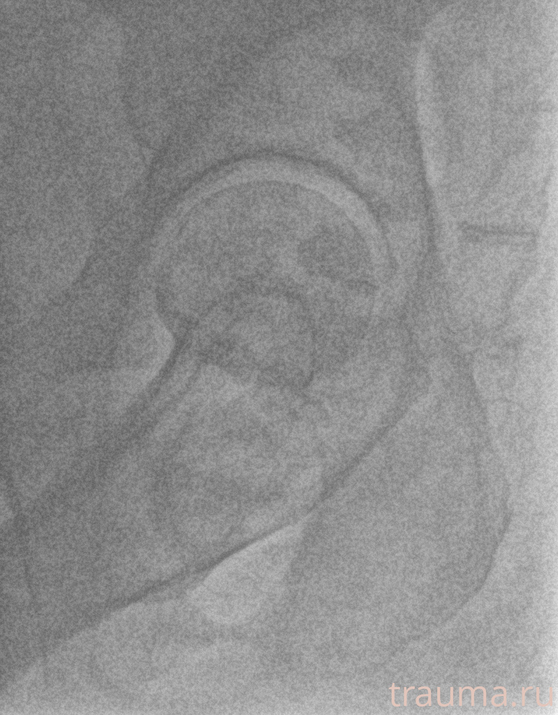 Рентген на дому: по вашему адресу приезжает врач-рентгенолог, травматолог-ортопед с мобильным рентгеновским аппаратом, проводит диагностику травмы или заболевания, делает необходимые рентгенограммы, дает рекомендации по дальнейшему лечению. Получить качественные снимки в домашних условиях возможно благодаря уникальной методике, разработанной МосРентген Центром для института  Склифосовского