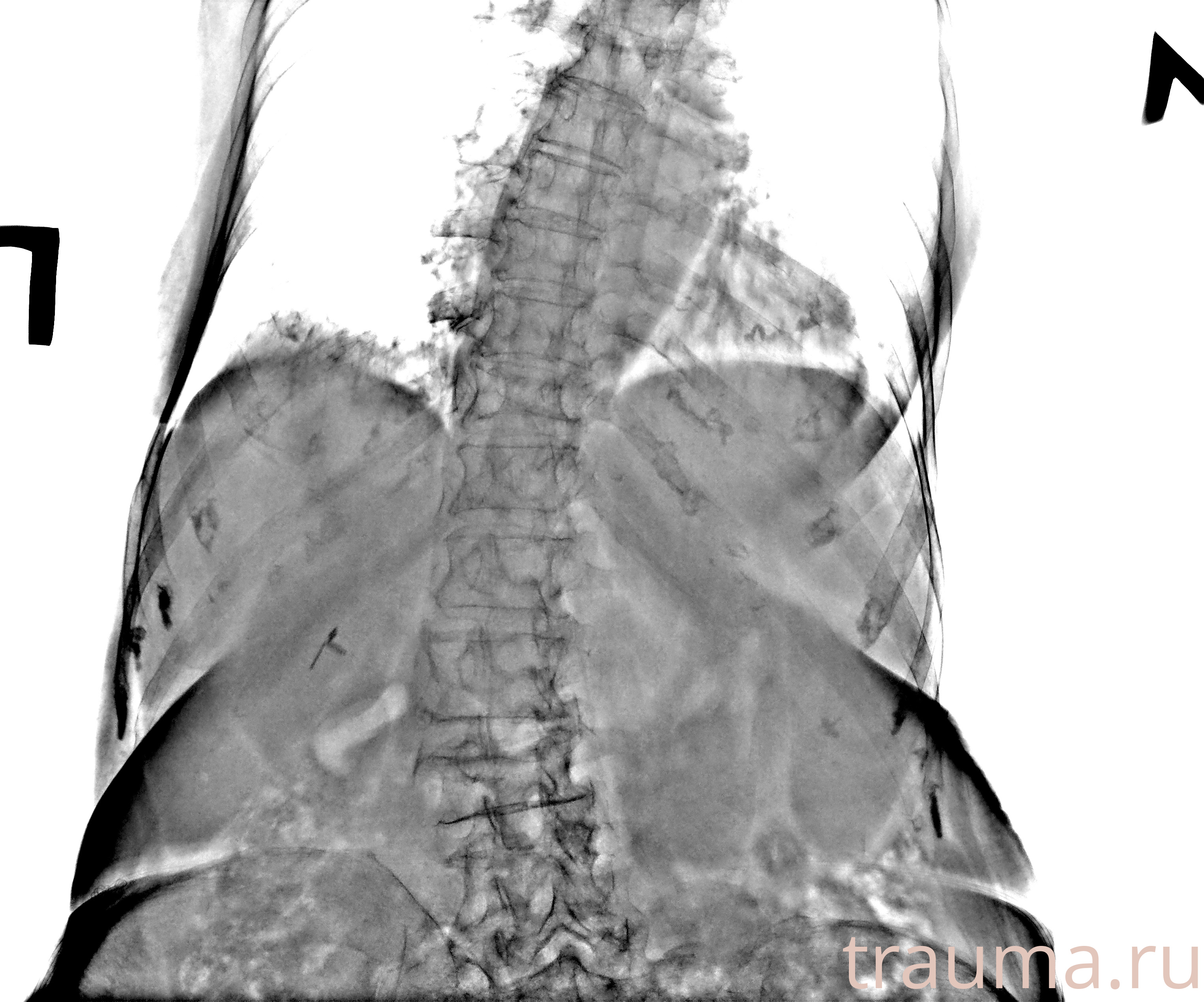 Рентген на дому: по вашему адресу приезжает врач-рентгенолог, травматолог-ортопед с мобильным рентгеновским аппаратом, проводит диагностику травмы или заболевания, делает необходимые рентгенограммы, дает рекомендации по дальнейшему лечению. Получить качественные снимки в домашних условиях возможно благодаря уникальной методике, разработанной МосРентген Центром для института  Склифосовского