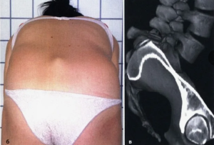 Роль классификации в определении стратегии лечения дегенеративного спондилолистеза