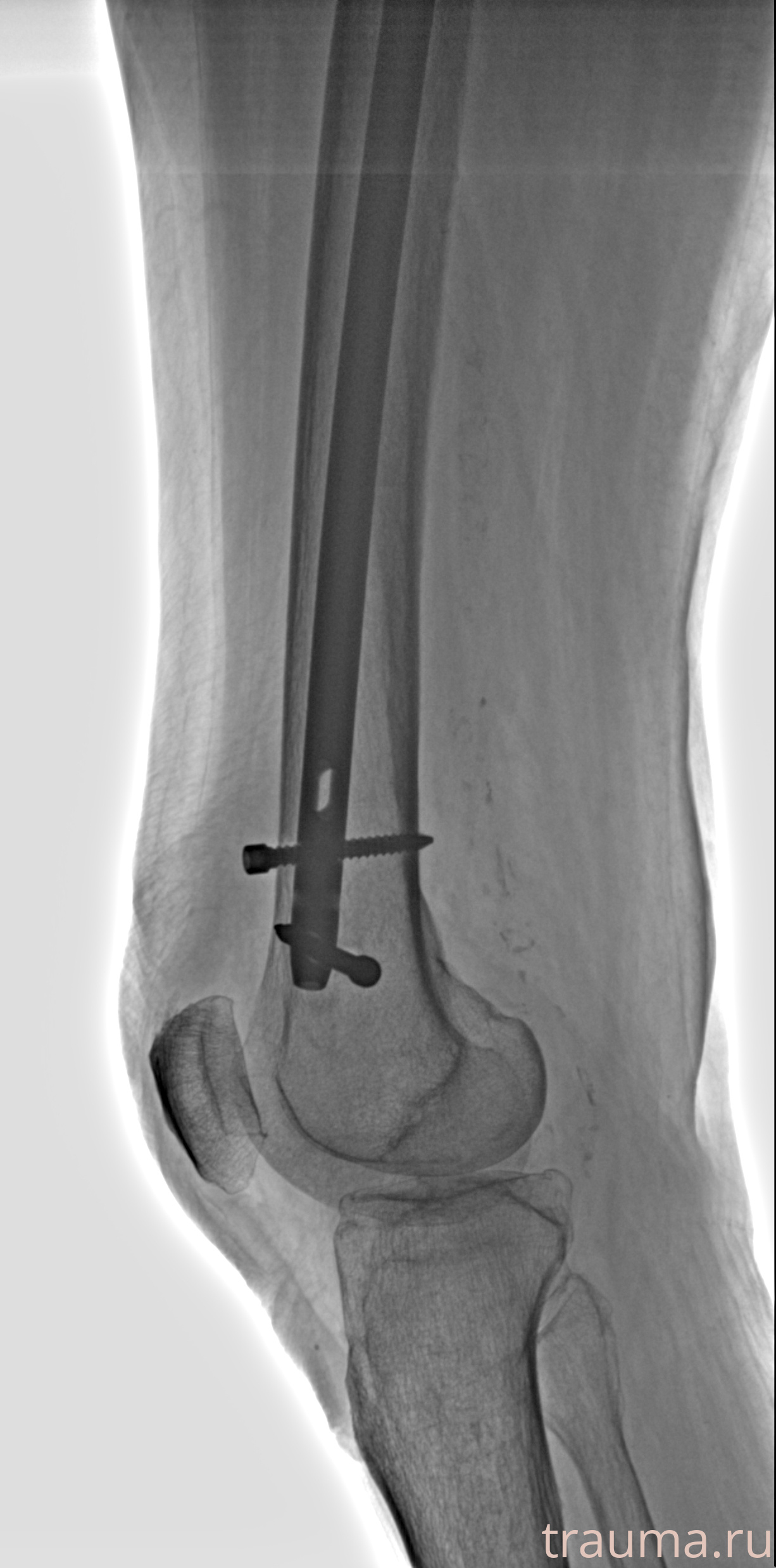 Рентген на дому: по вашему адресу приезжает врач-рентгенолог, травматолог-ортопед с мобильным рентгеновским аппаратом, проводит диагностику травмы или заболевания, делает необходимые рентгенограммы, дает рекомендации по дальнейшему лечению. Получить качественные снимки в домашних условиях возможно благодаря уникальной методике, разработанной МосРентген Центром для института  Склифосовского