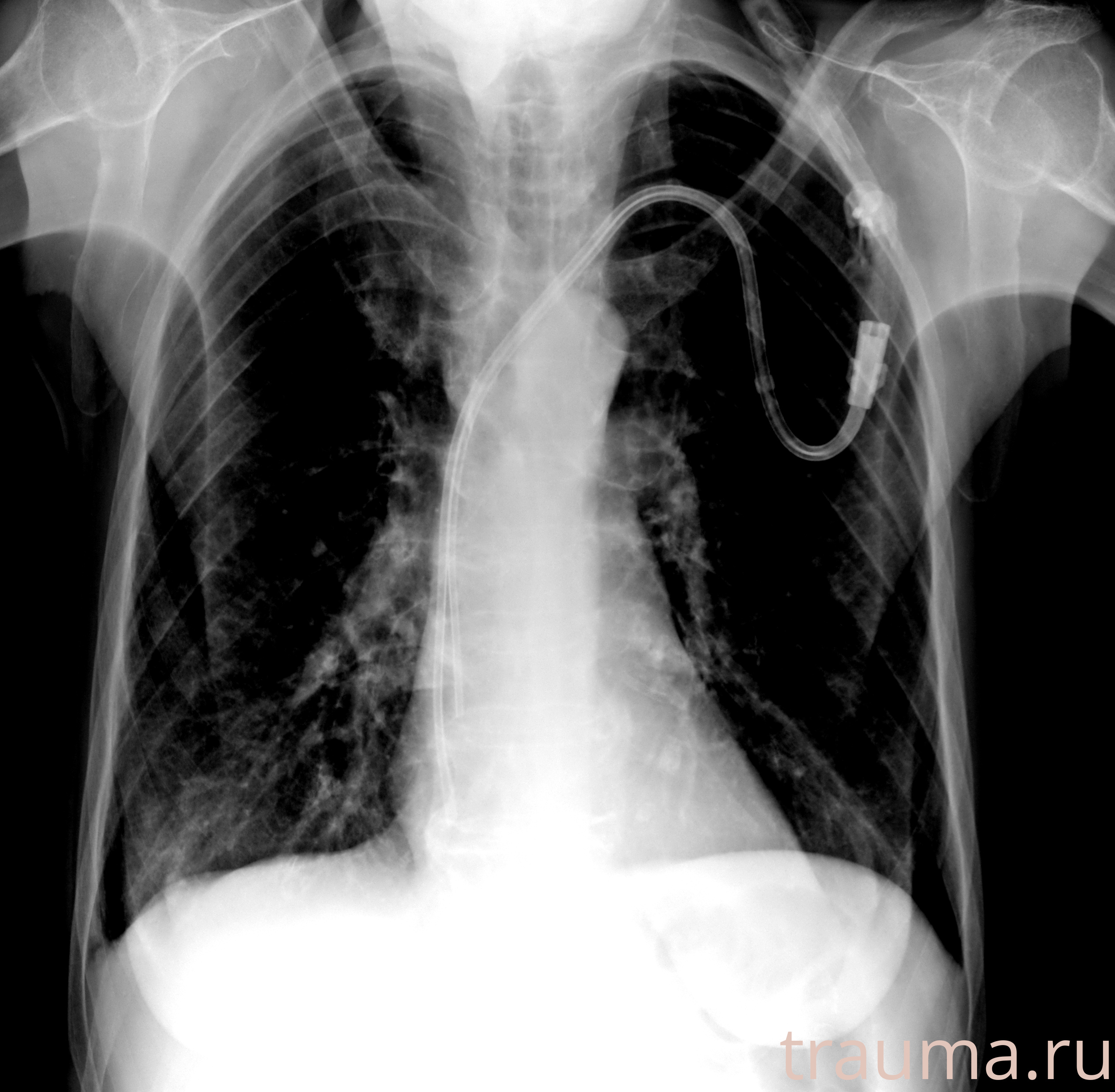 Рентген на дому: по вашему адресу приезжает врач-рентгенолог, травматолог-ортопед с мобильным рентгеновским аппаратом, проводит диагностику травмы или заболевания, делает необходимые рентгенограммы, дает рекомендации по дальнейшему лечению. Получить качественные снимки в домашних условиях возможно благодаря уникальной методике, разработанной МосРентген Центром для института  Склифосовского