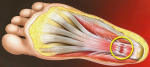 Особенности развития физических качеств у школьников с плоскостопием
