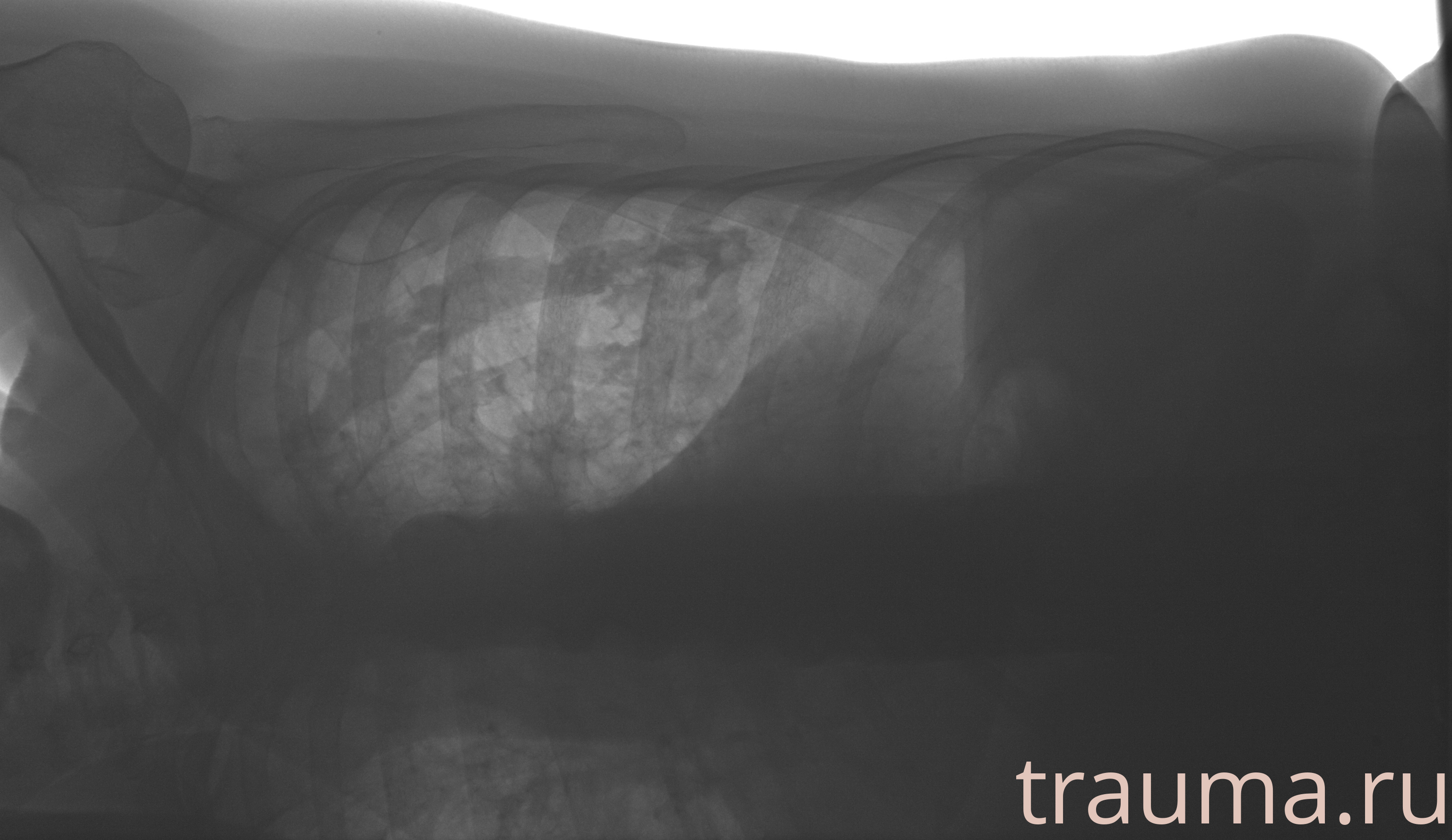 Рентген на дому: по вашему адресу приезжает врач-рентгенолог, травматолог-ортопед с мобильным рентгеновским аппаратом, проводит диагностику травмы или заболевания, делает необходимые рентгенограммы, дает рекомендации по дальнейшему лечению. Получить качественные снимки в домашних условиях возможно благодаря уникальной методике, разработанной МосРентген Центром для института  Склифосовского
