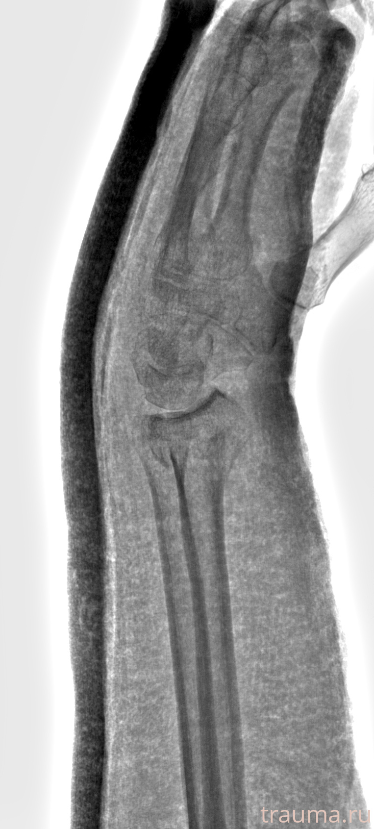 Рентген на дому: по вашему адресу приезжает врач-рентгенолог, травматолог-ортопед с мобильным рентгеновским аппаратом, проводит диагностику травмы или заболевания, делает необходимые рентгенограммы, дает рекомендации по дальнейшему лечению. Получить качественные снимки в домашних условиях возможно благодаря уникальной методике, разработанной МосРентген Центром для института  Склифосовского