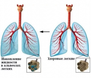 Дифференциальная рентгенодиагностика заболеваний органов дыхания и средостения(часть 10)
