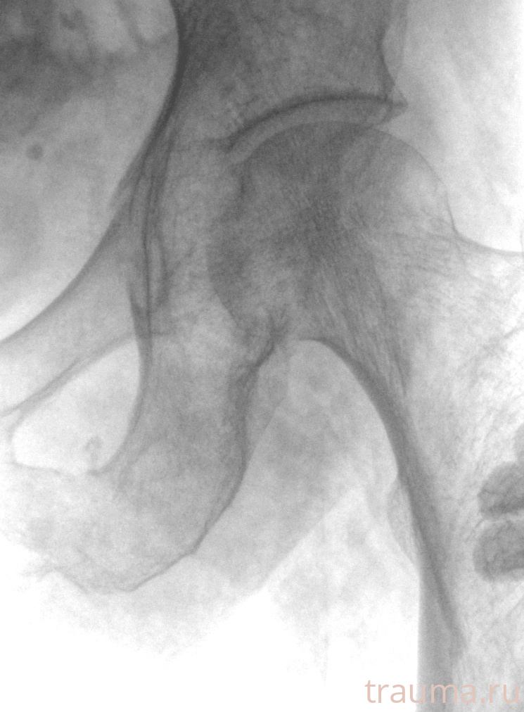 Рентген на дому: по вашему адресу приезжает врач-рентгенолог, травматолог-ортопед с мобильным рентгеновским аппаратом, проводит диагностику травмы или заболевания, делает необходимые рентгенограммы, дает рекомендации по дальнейшему лечению. Получить качественные снимки в домашних условиях возможно благодаря уникальной методике, разработанной МосРентген Центром для института  Склифосовского