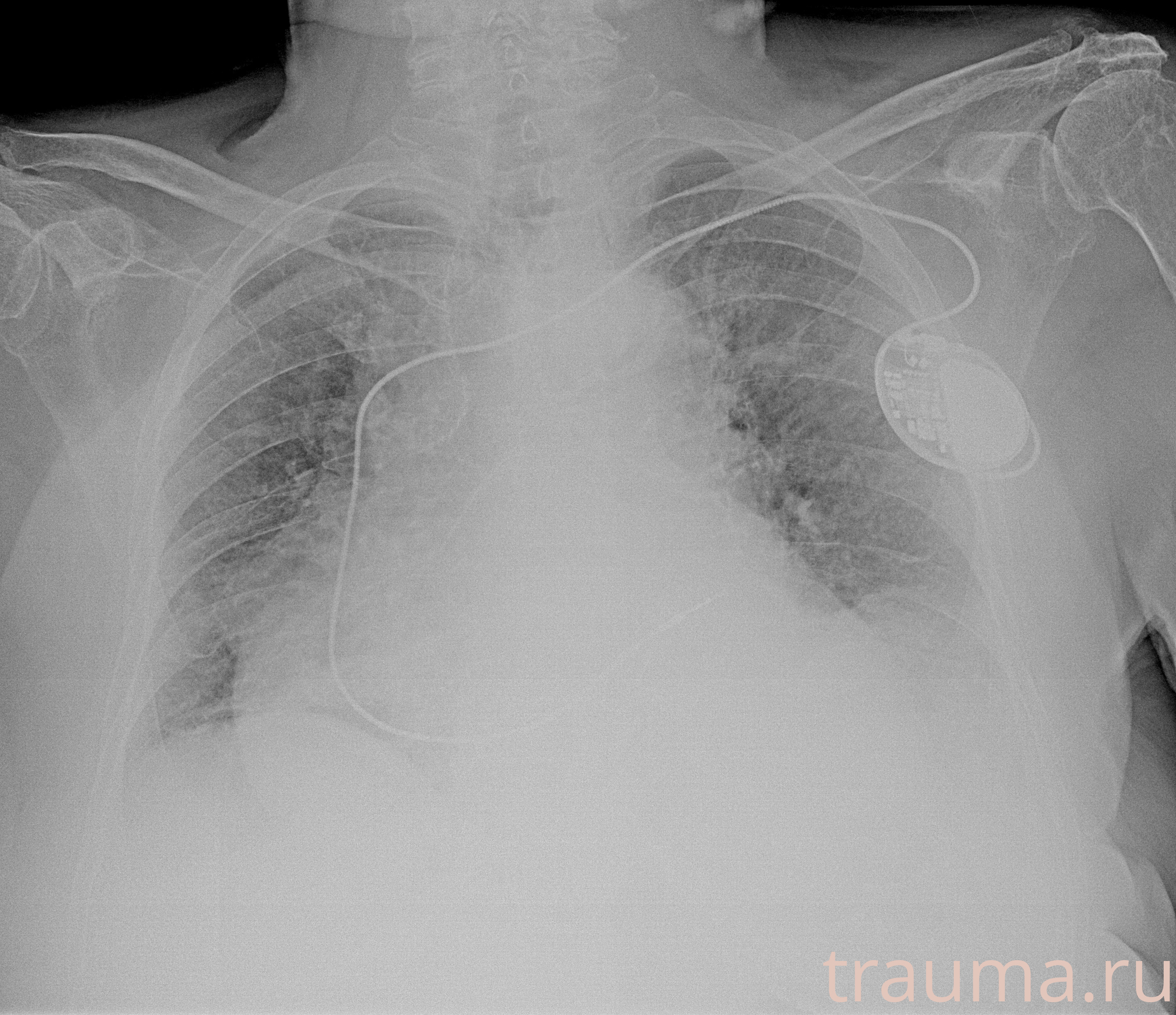 Рентген на дому: по вашему адресу приезжает врач-рентгенолог, травматолог-ортопед с мобильным рентгеновским аппаратом, проводит диагностику травмы или заболевания, делает необходимые рентгенограммы, дает рекомендации по дальнейшему лечению. Получить качественные снимки в домашних условиях возможно благодаря уникальной методике, разработанной МосРентген Центром для института  Склифосовского